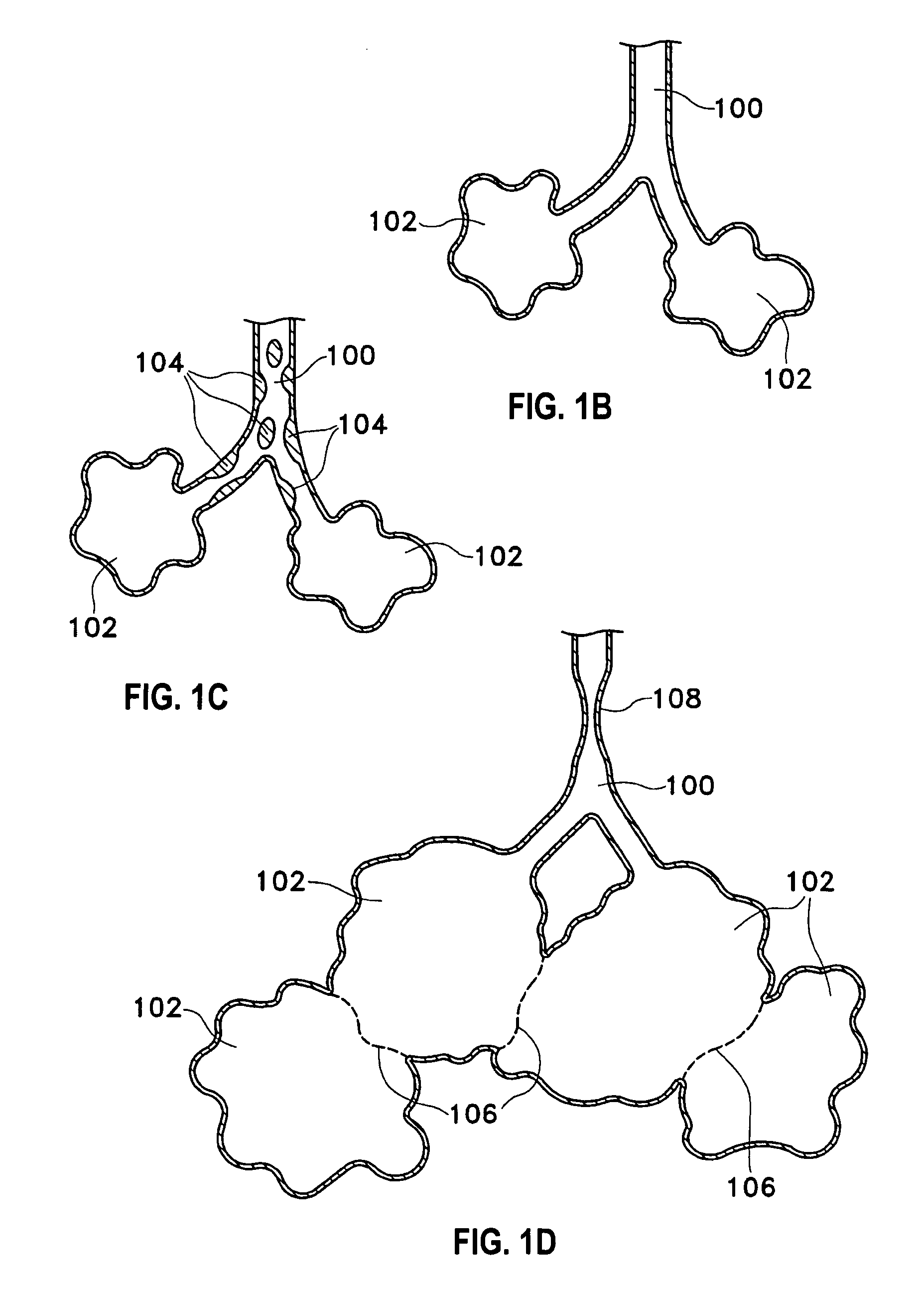 Extrapleural airway device and method