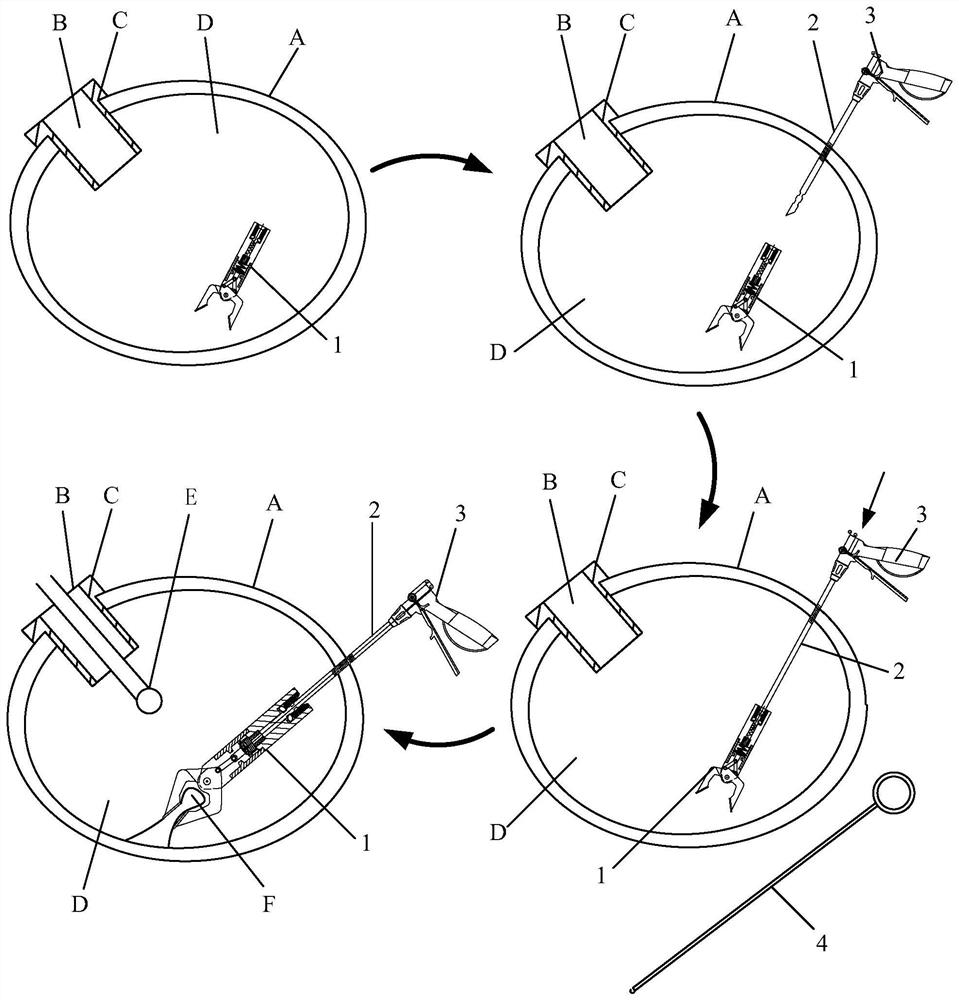 Endovascular surgery system