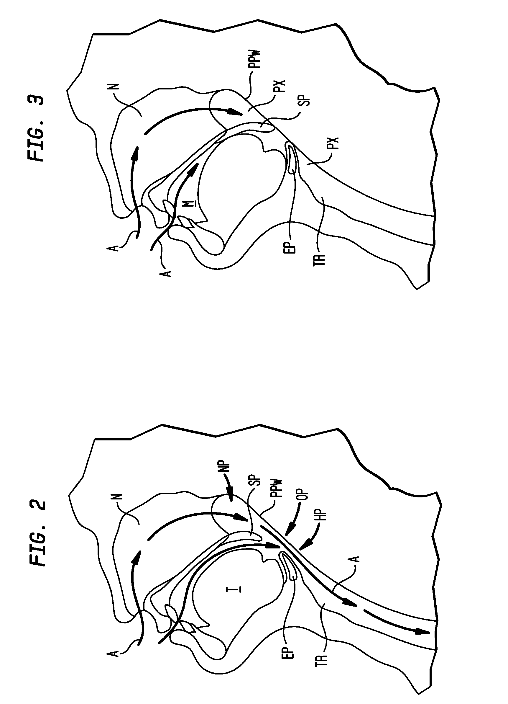 Implant systems and methods for treating obstructive sleep apnea