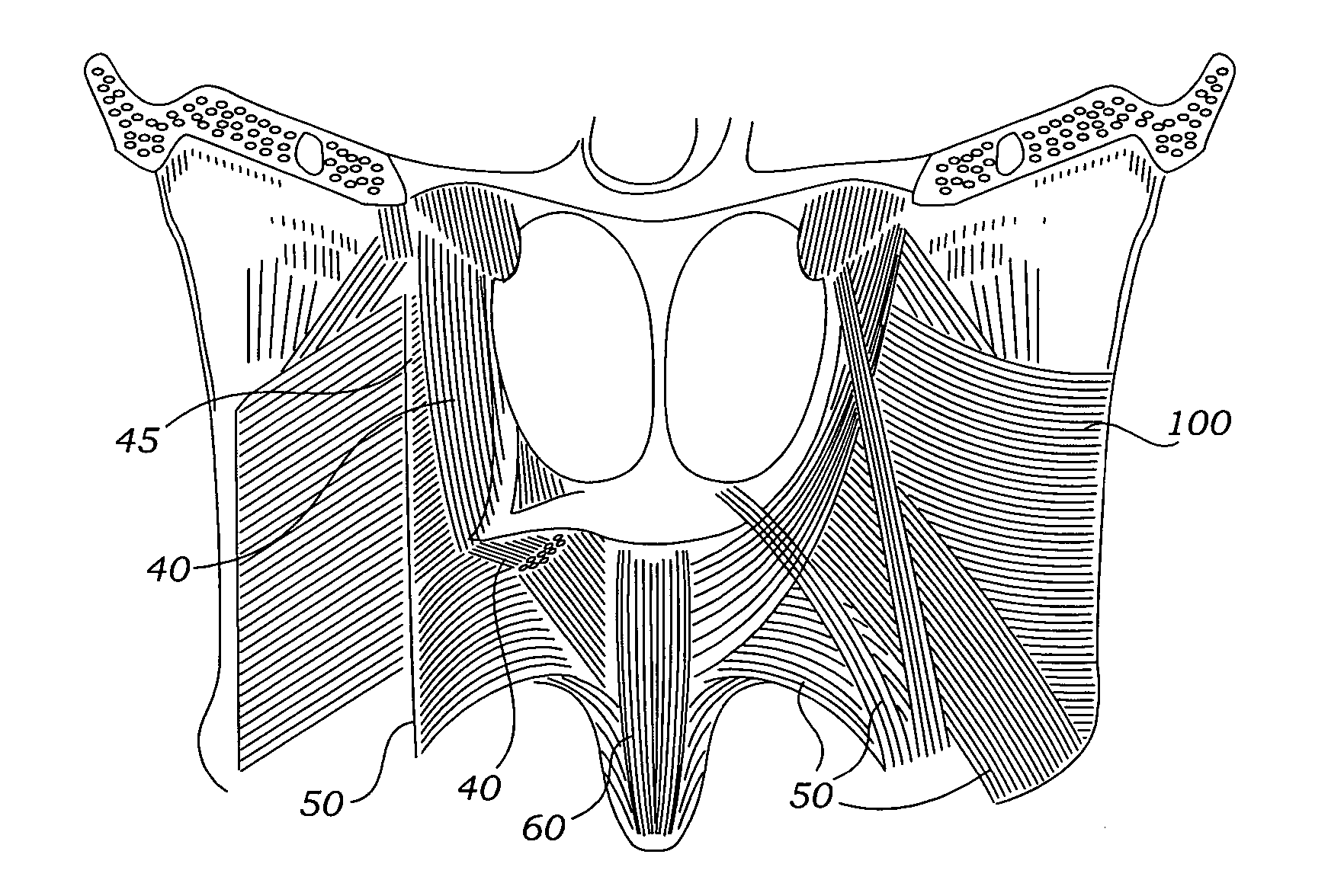 Method for treating sleep apnea and snoring