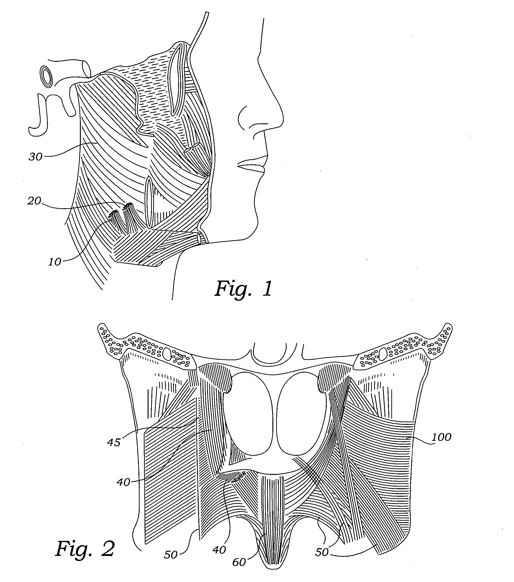 Method for treating sleep apnea and snoring