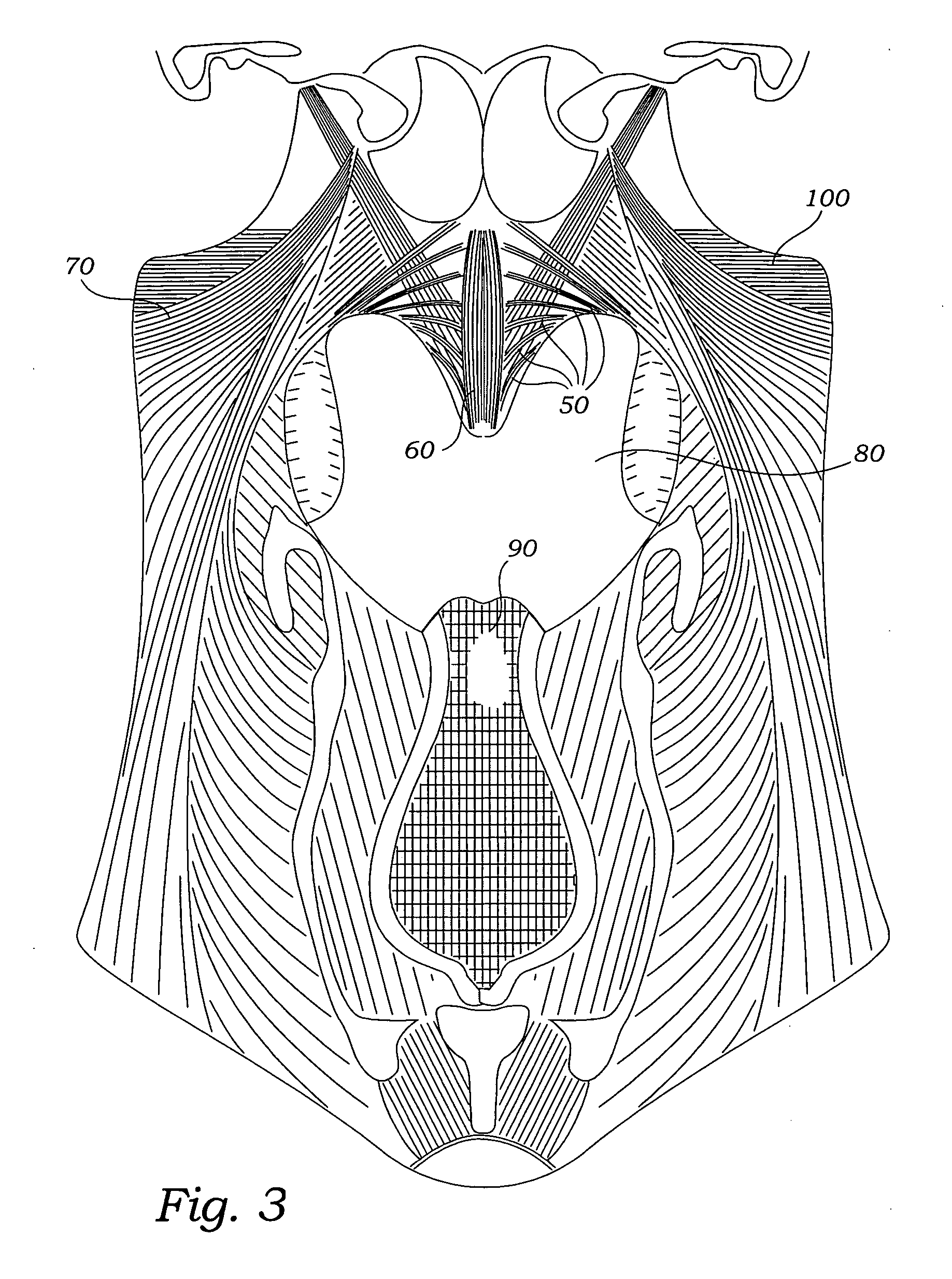 Method for treating sleep apnea and snoring