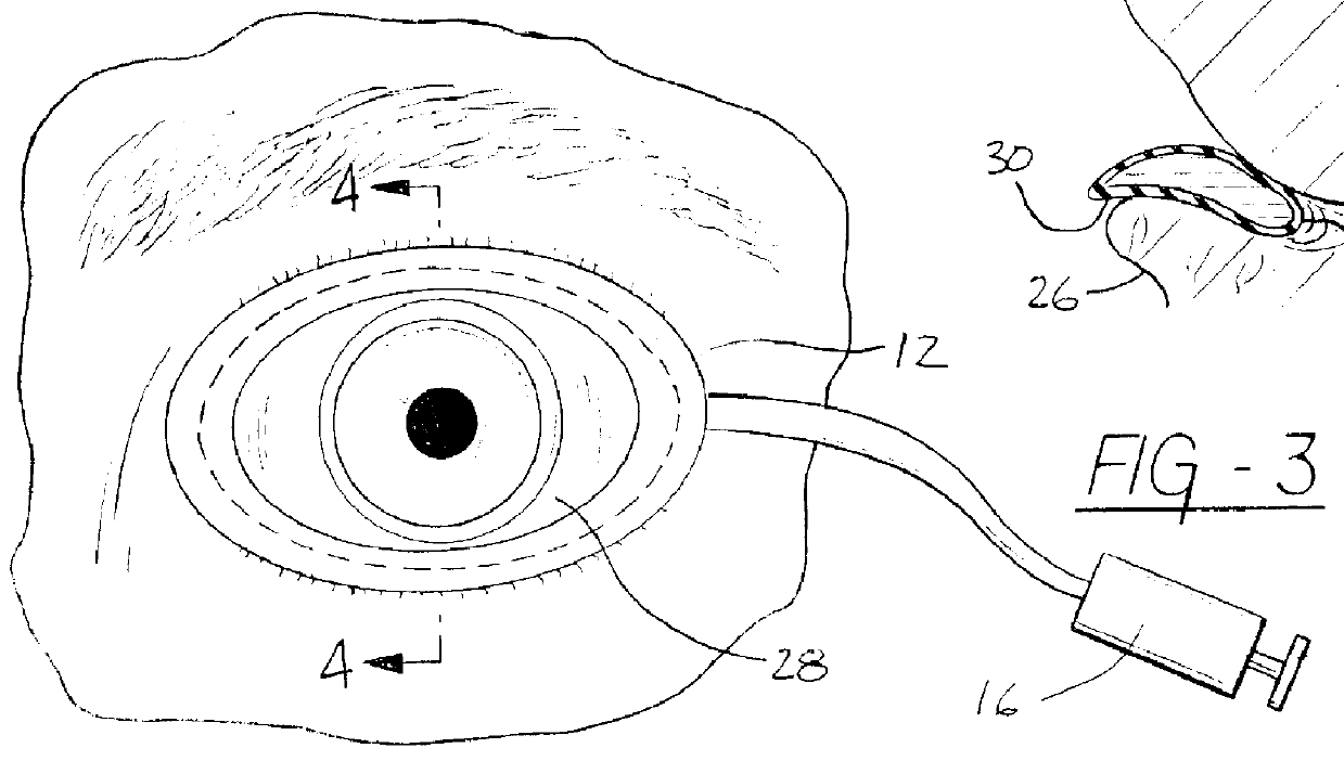 Eyelid speculum