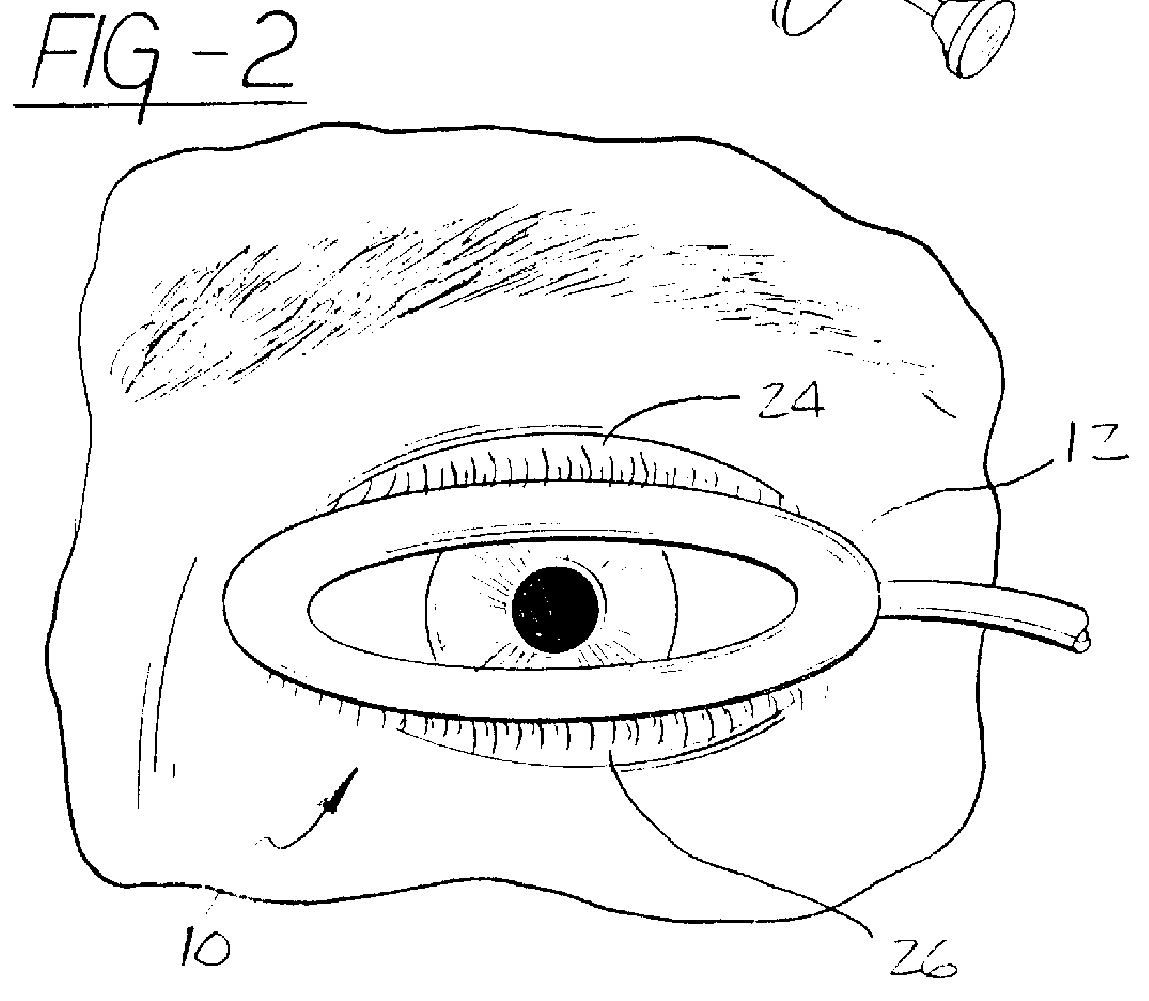 Eyelid speculum