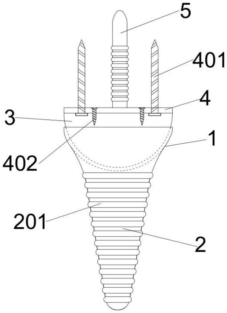 Wrist joint prosthesis with surface hydroxyapatite HA modified microporous titanium