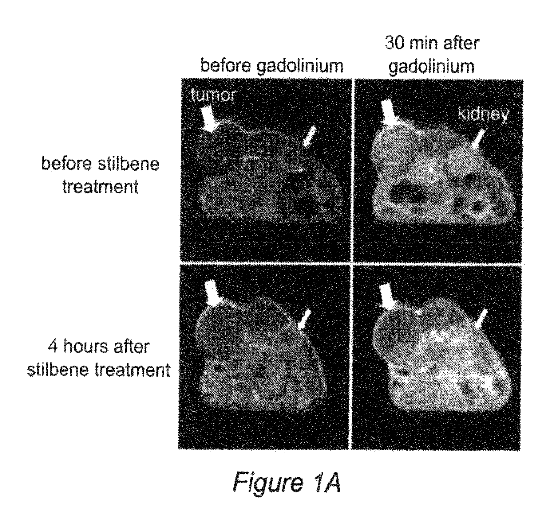 Induction of tumor hypoxia for cancer therapy