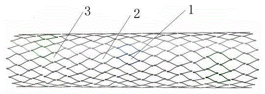 Carotid artery stent system