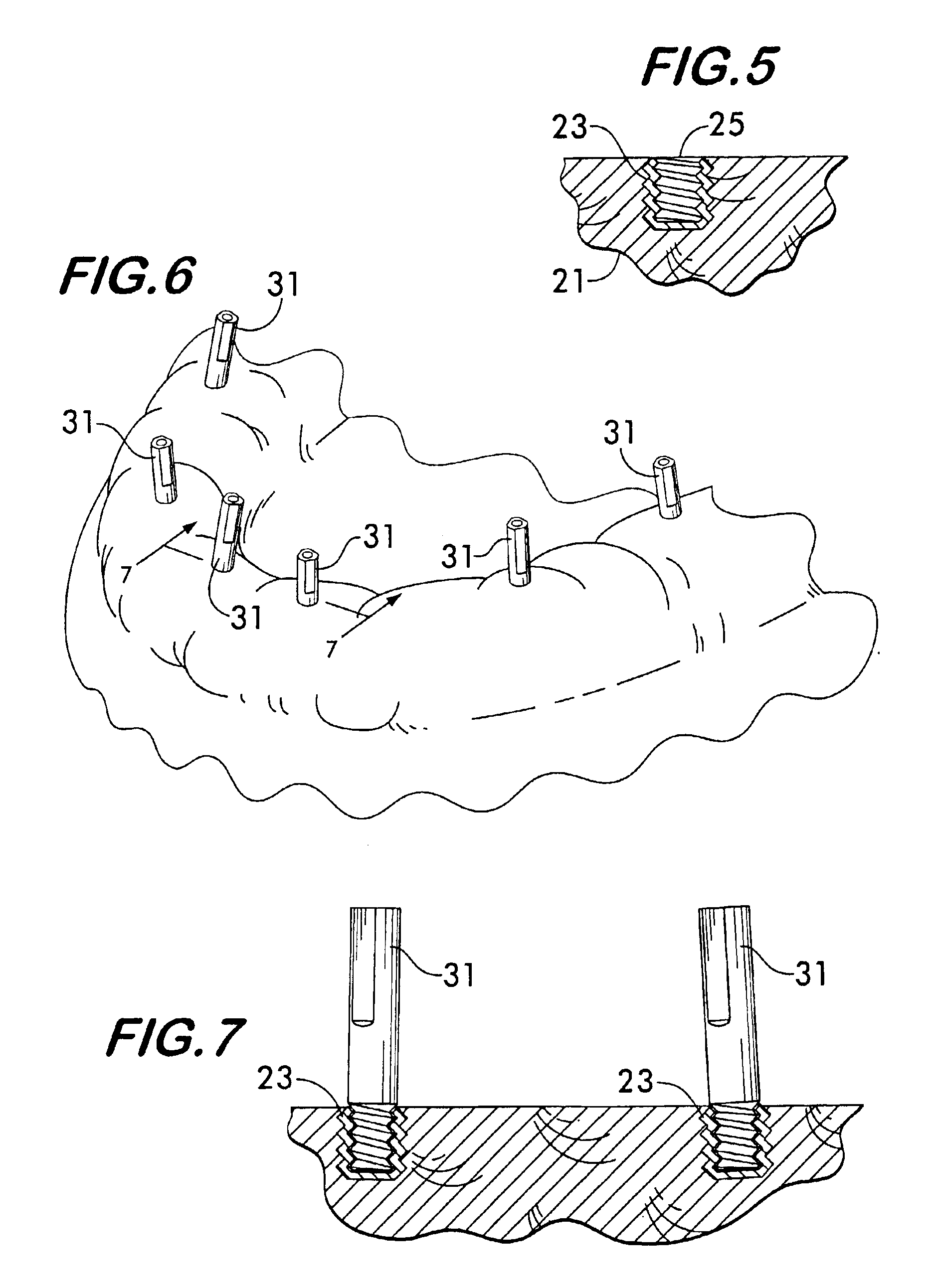 Impression support system for dental implants