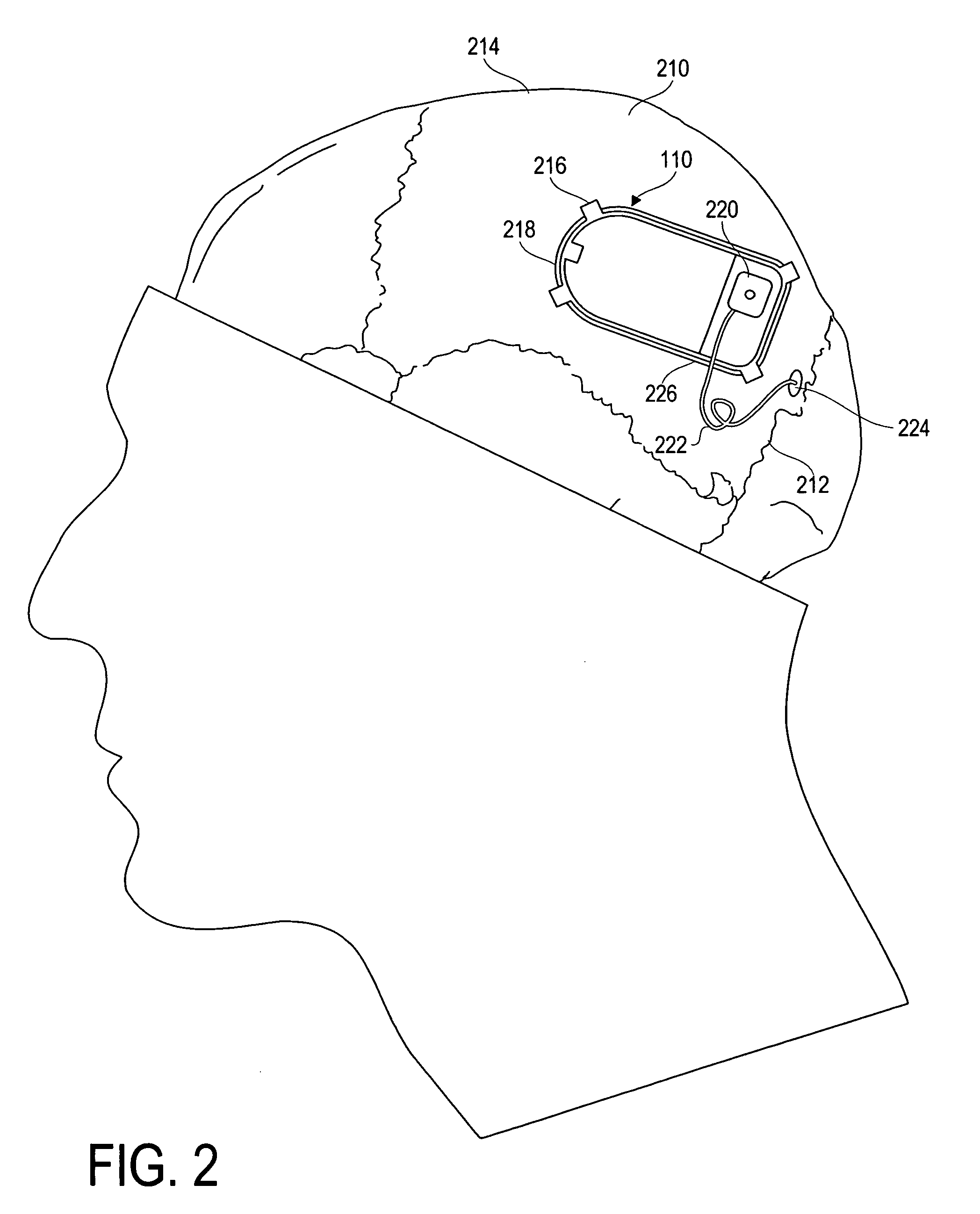 Modulation and analysis of cerebral perfusion in epilepsy and other neurological disorders