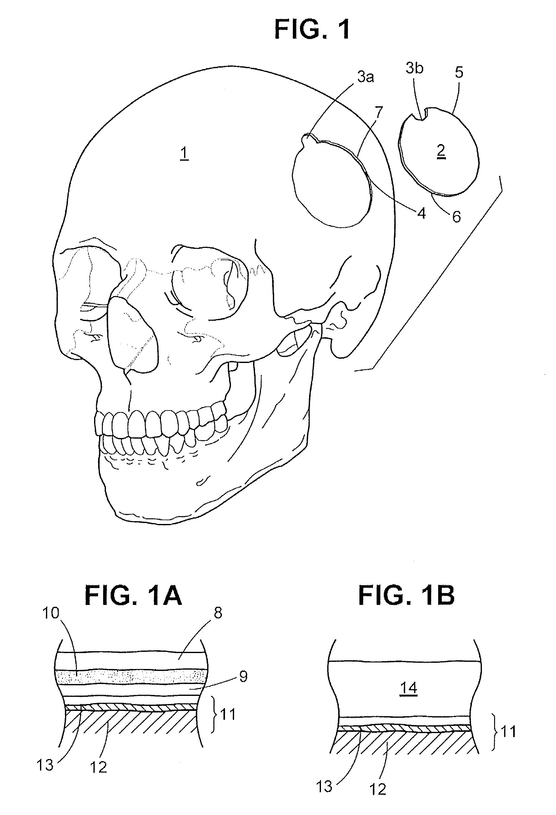 Craniotomy Closures and Plugs