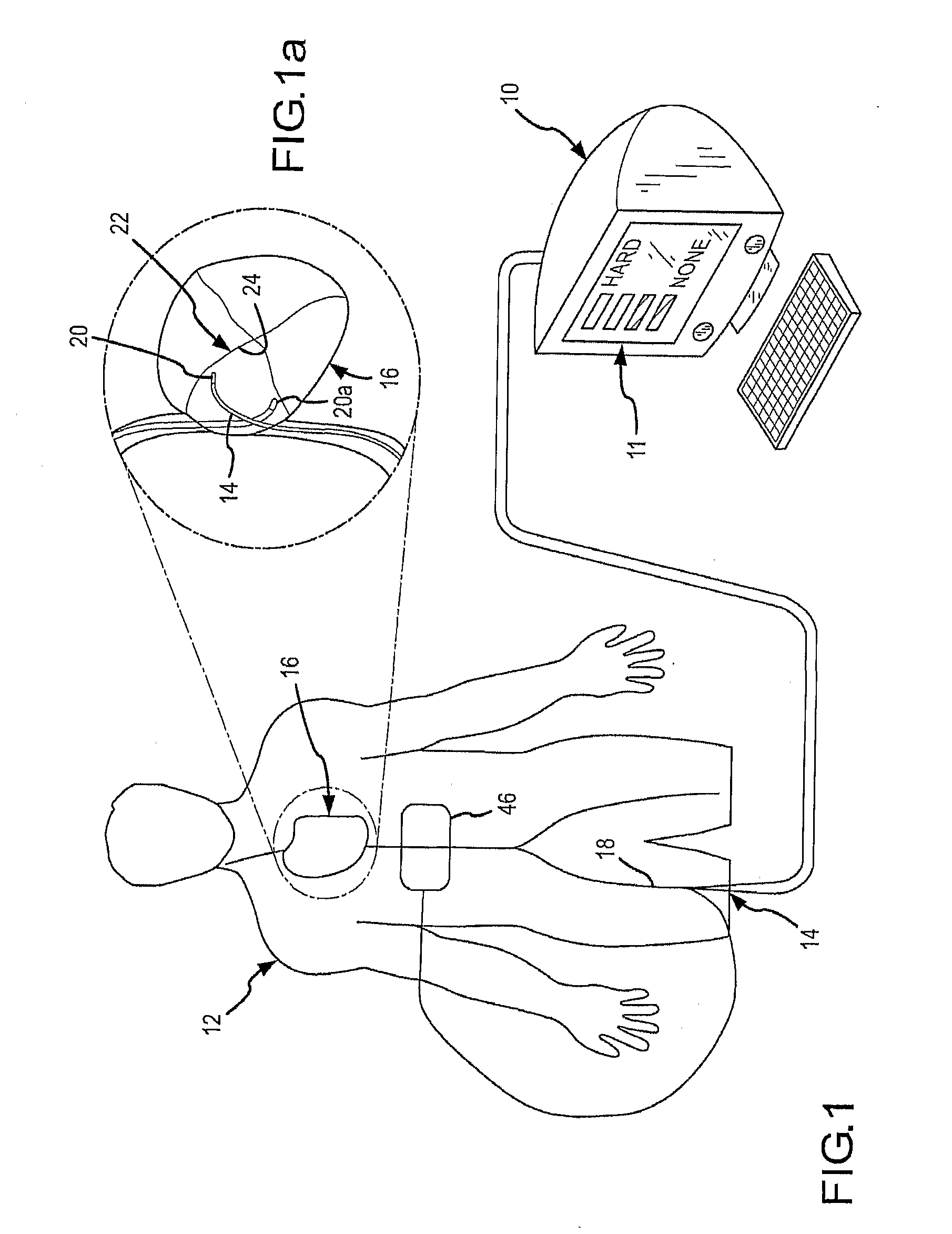 Design of Handle Set for Ablation Catheter with Indicators of Catheter and Tissue Parameters