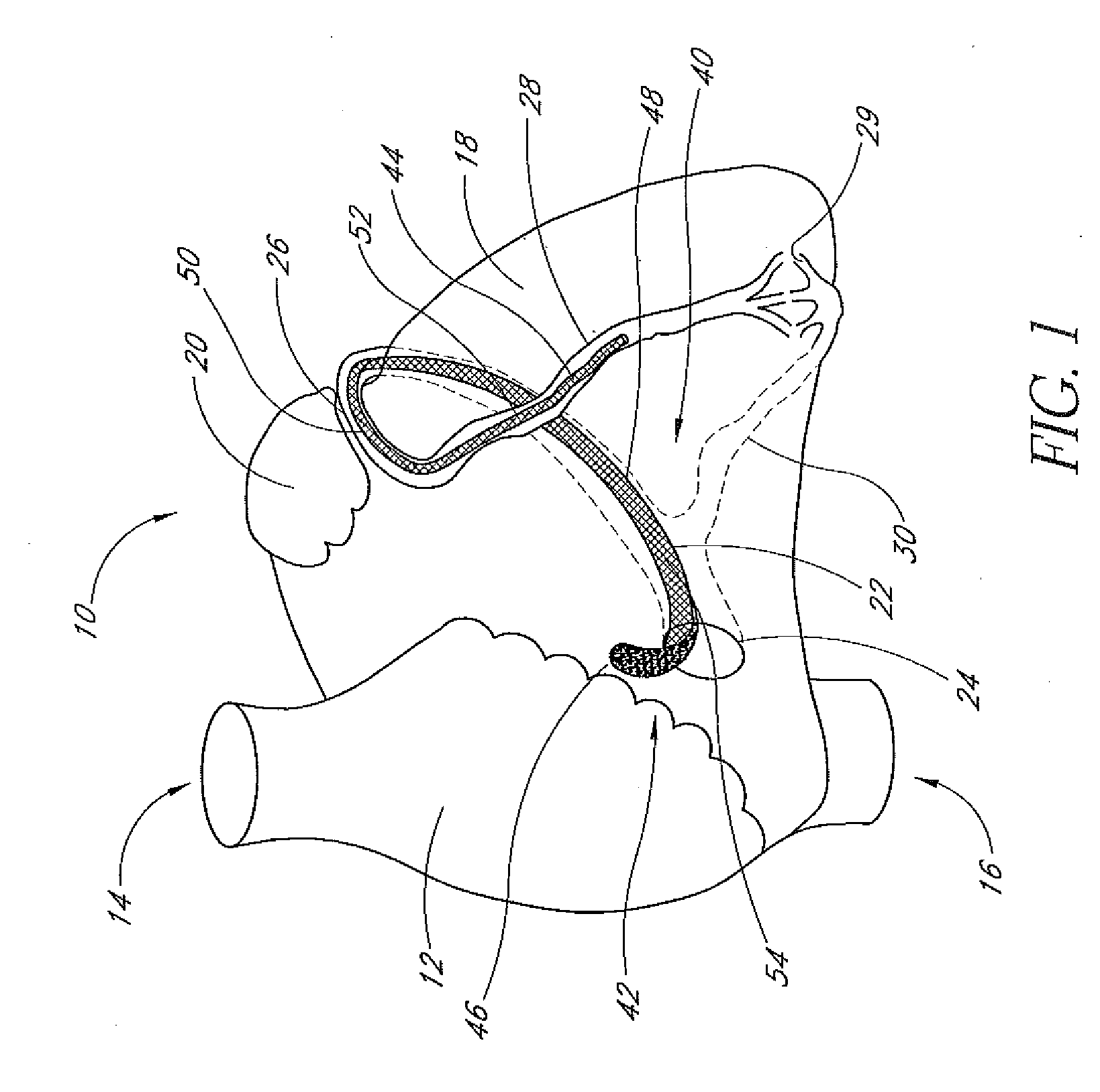 Percutaneous mitral annulplasty with cardiac rhythm management