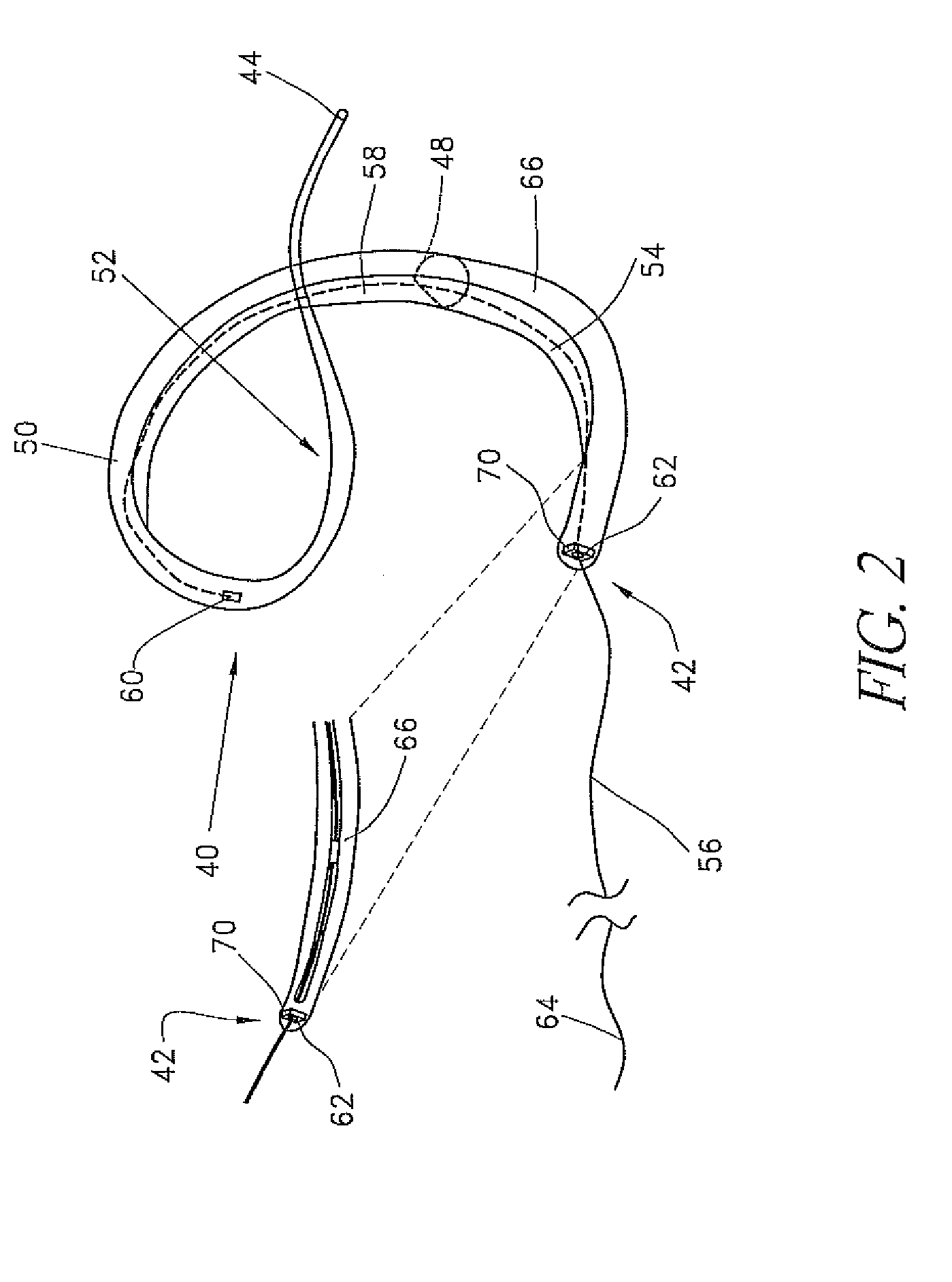 Percutaneous mitral annulplasty with cardiac rhythm management