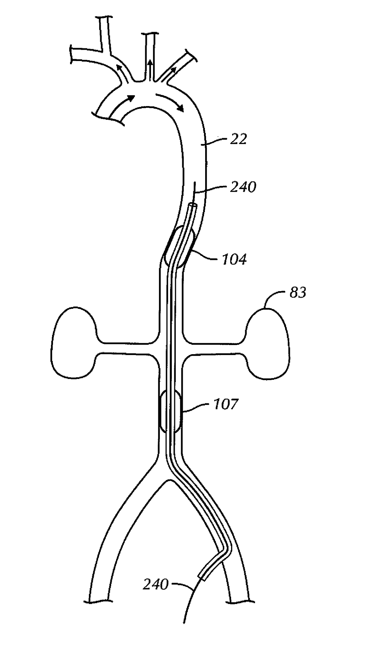 Aortic occluder with tensioned balloons