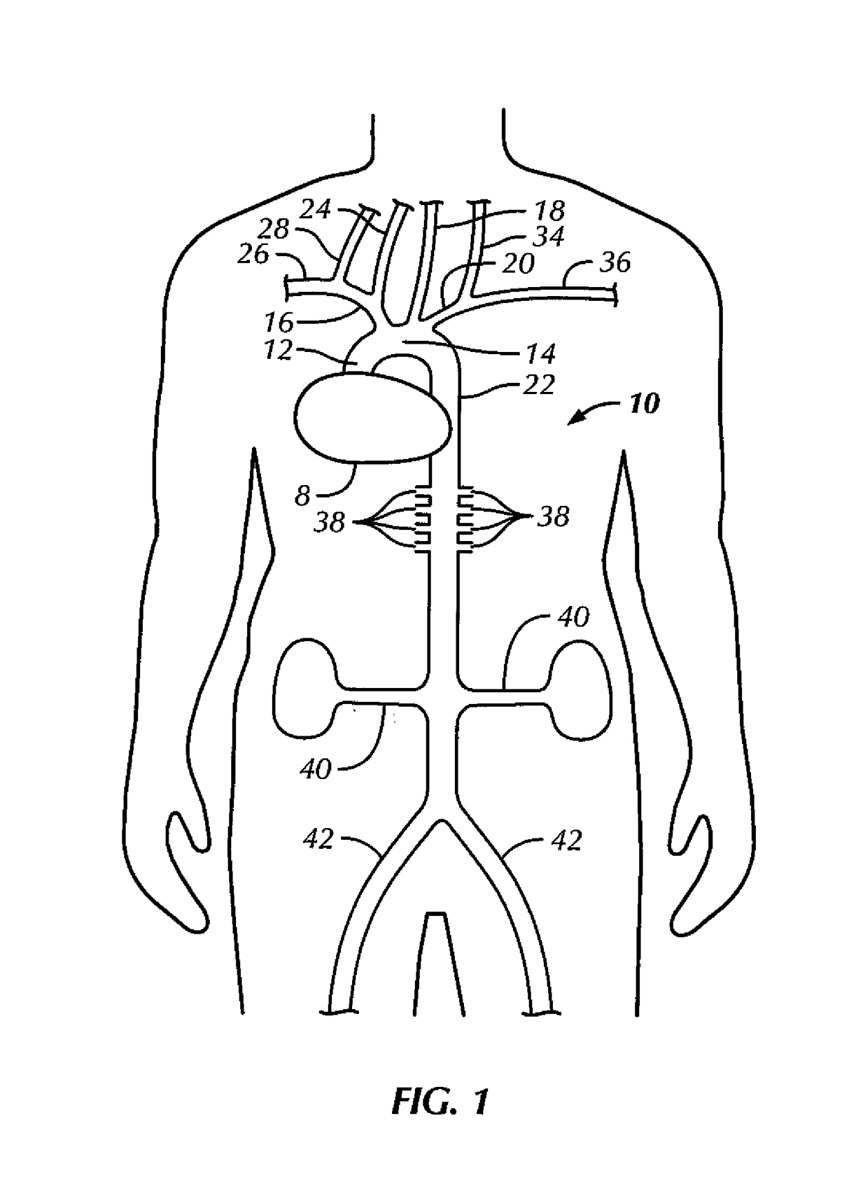 Aortic occluder with tensioned balloons