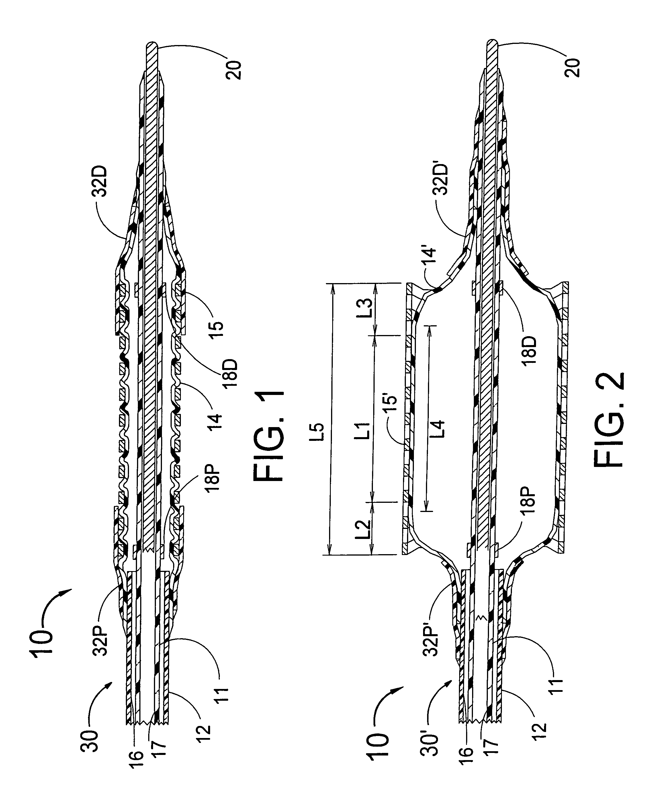 Stent with self-expanding end sections