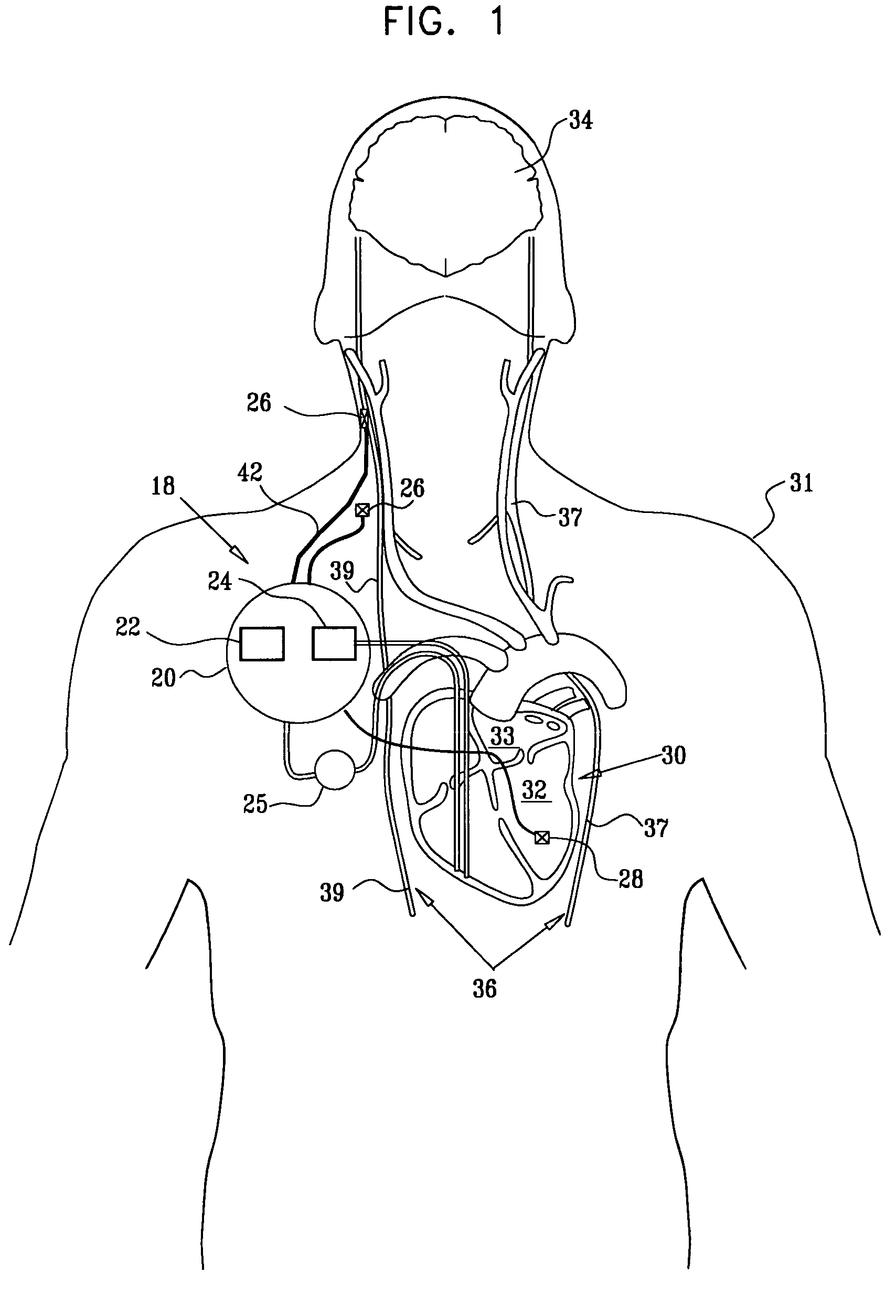 Techniques for reducing pain associated with nerve stimulation