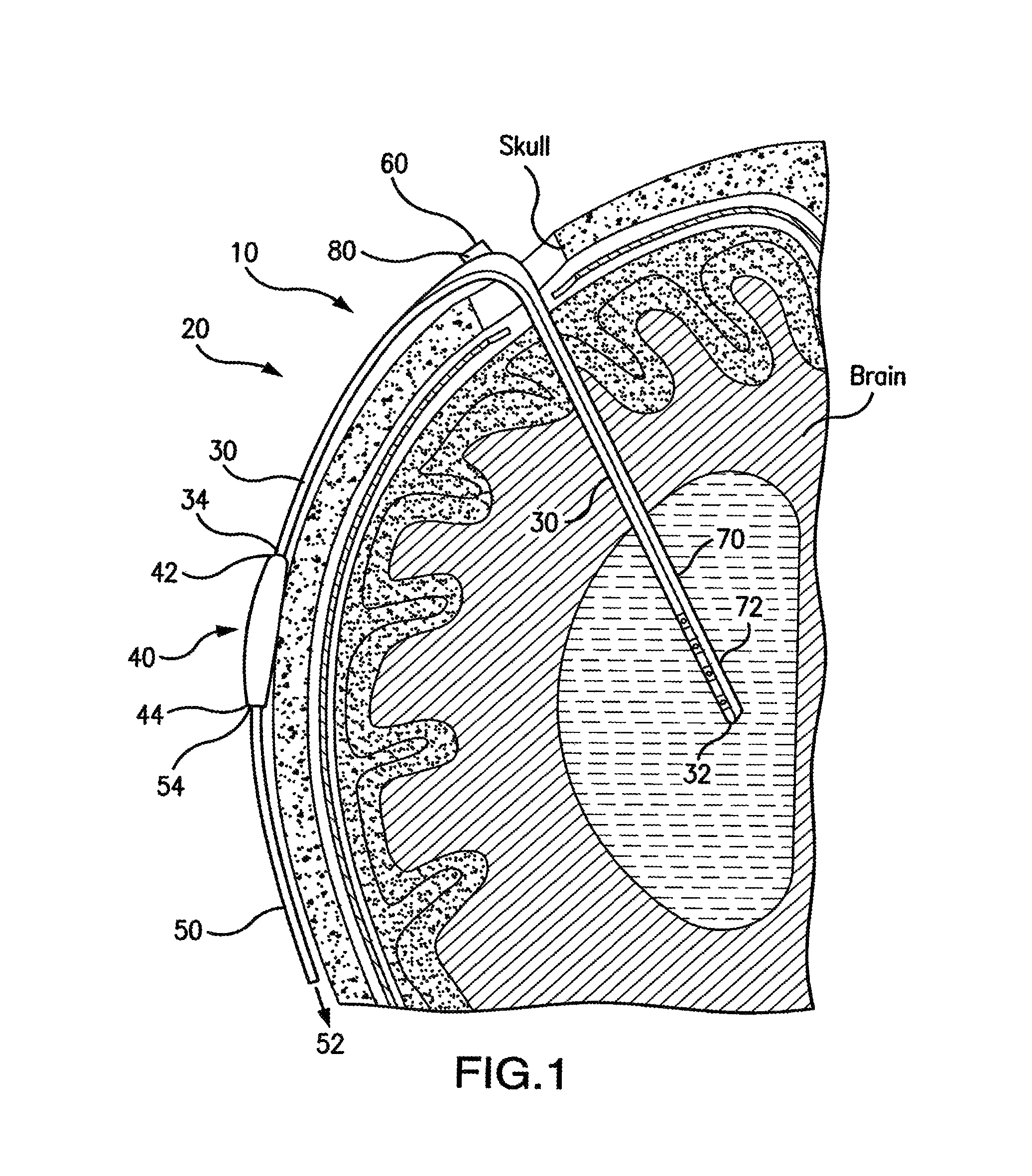 Ventricular shunt system and method