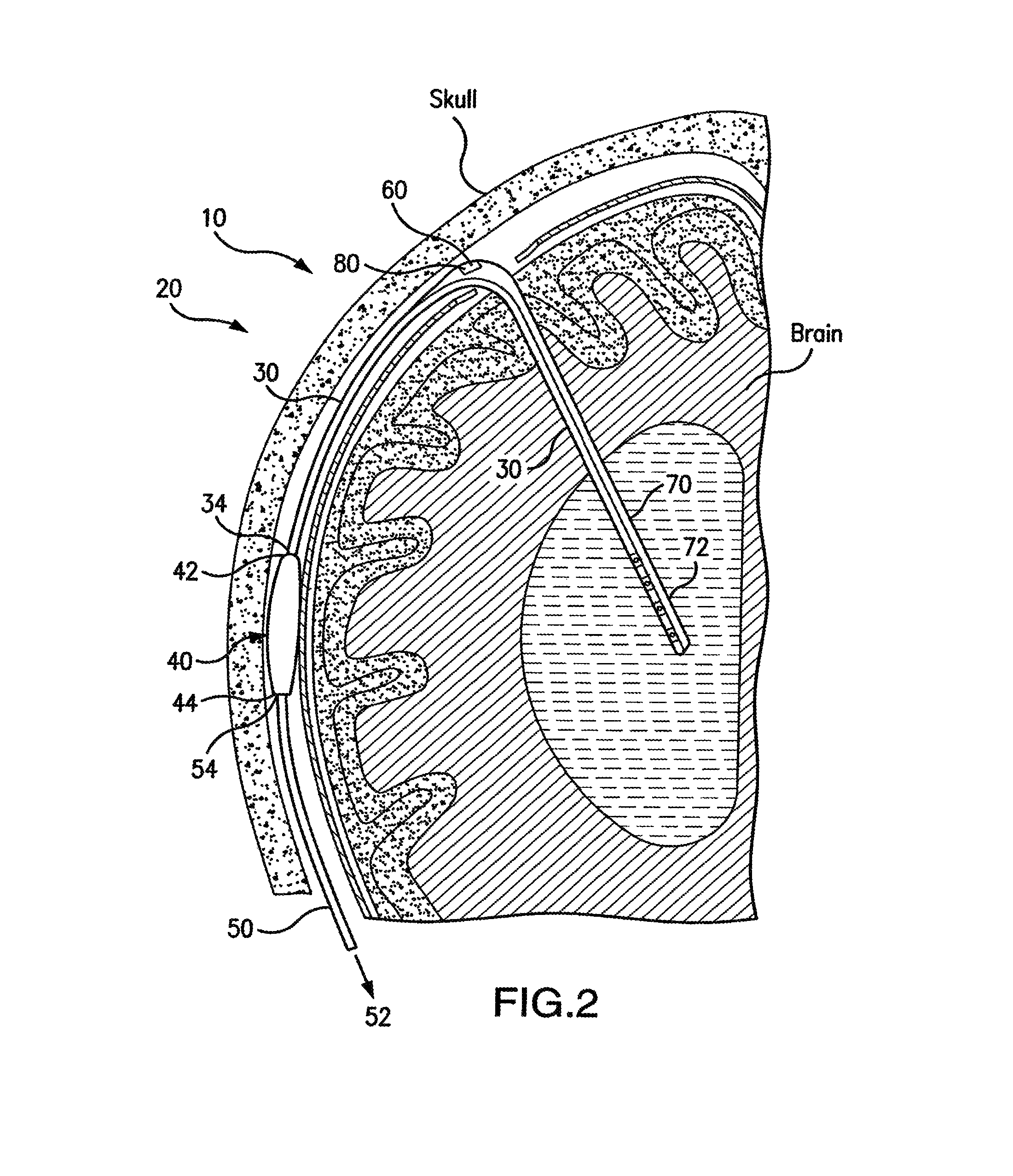 Ventricular shunt system and method