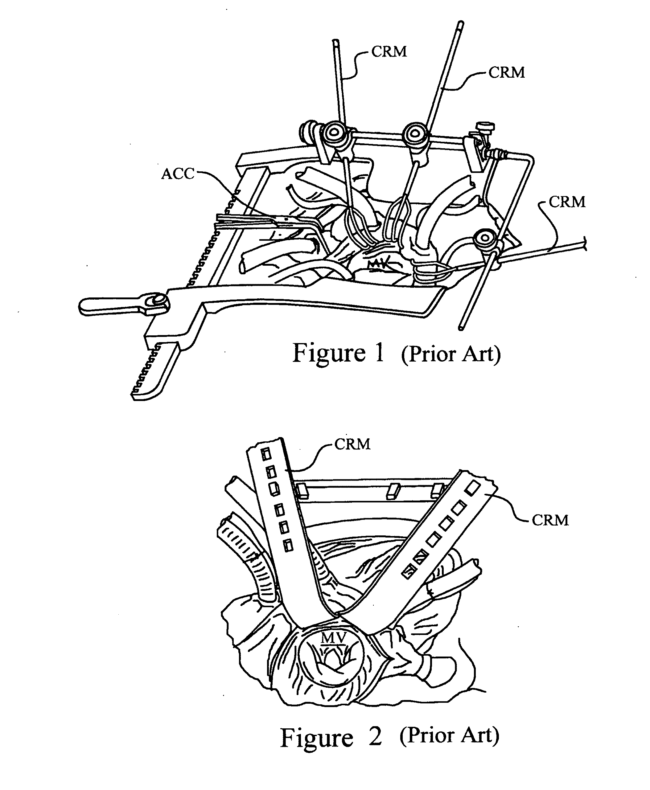 Cardiac tissue retractor with associated valve cusp depressor