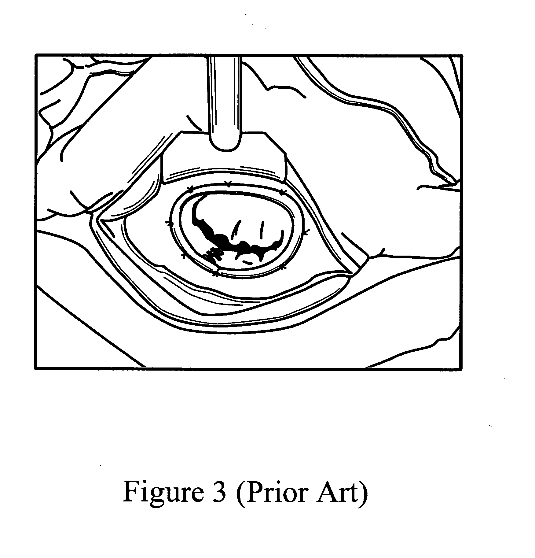 Cardiac tissue retractor with associated valve cusp depressor