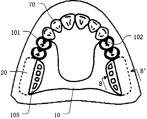 Partial denture capable of being picked off and making technology thereof