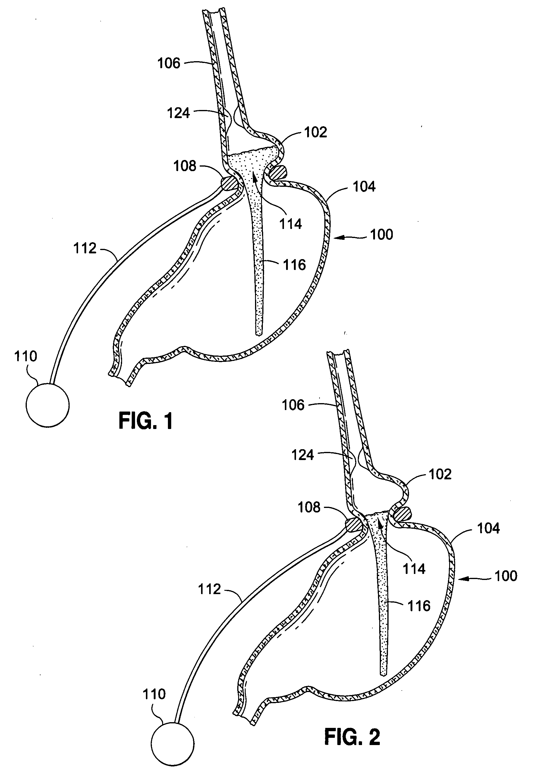 External sensing system for gastric restriction devices