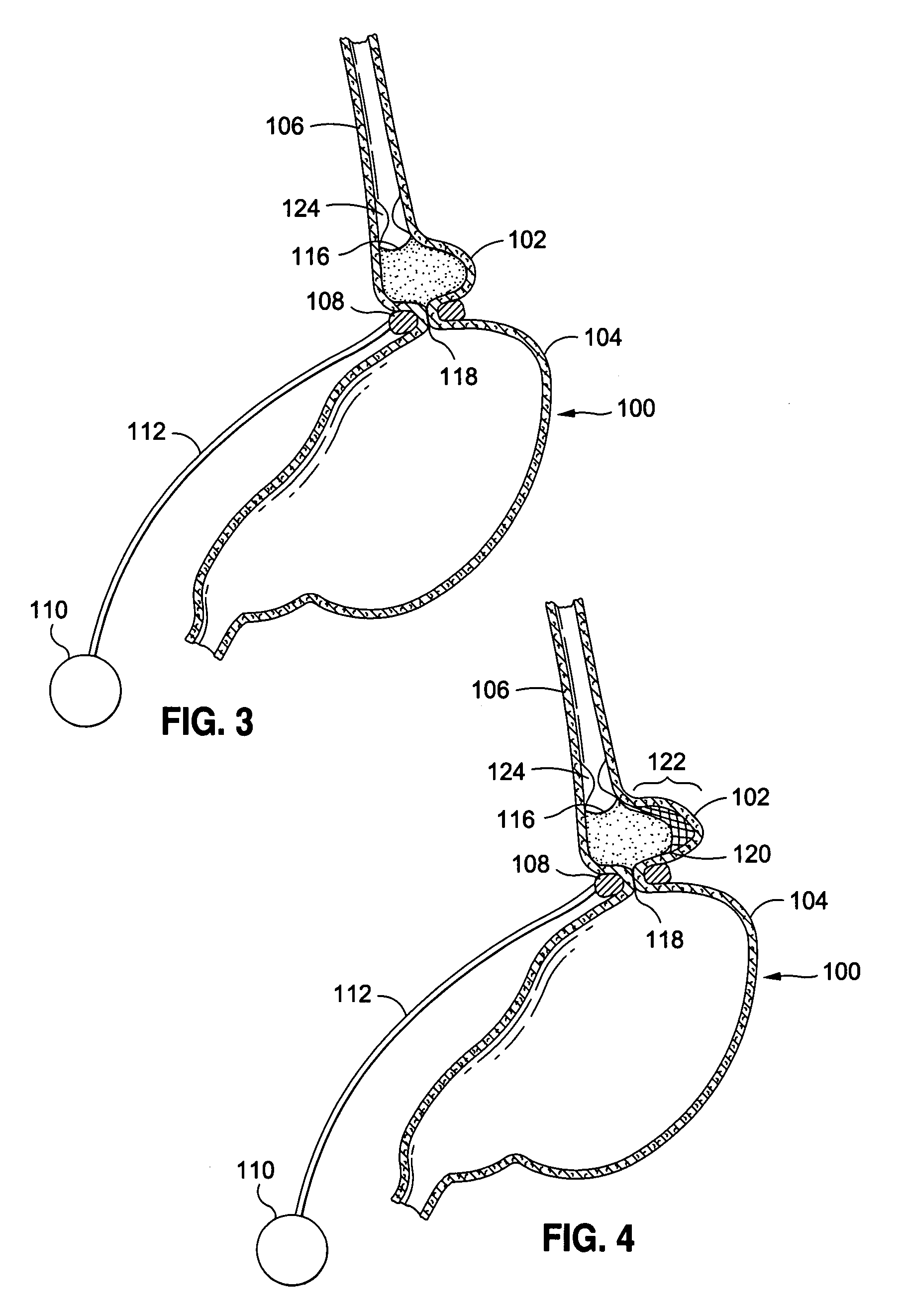 External sensing system for gastric restriction devices