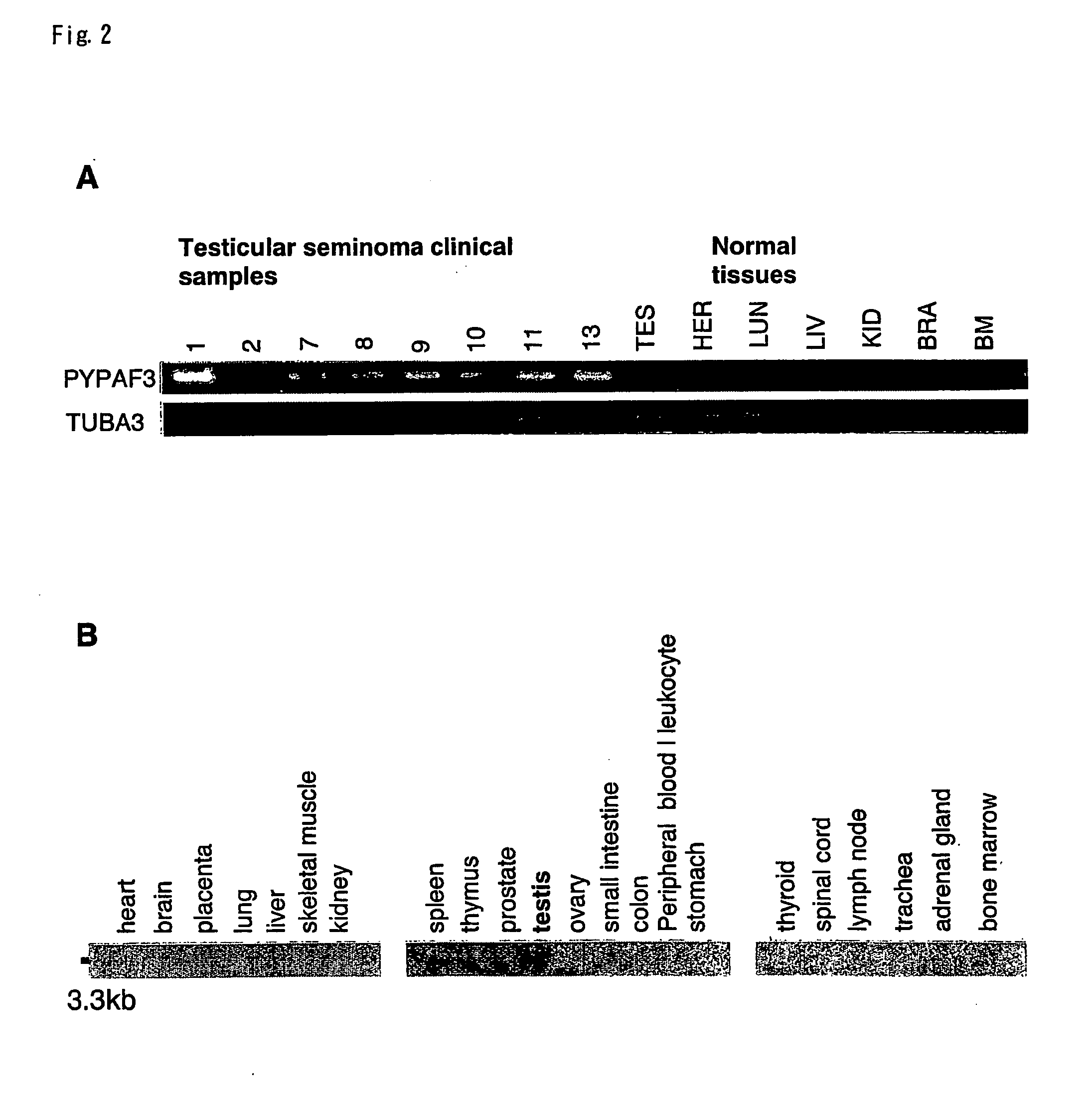 Method for diagnosing testicular seminomas