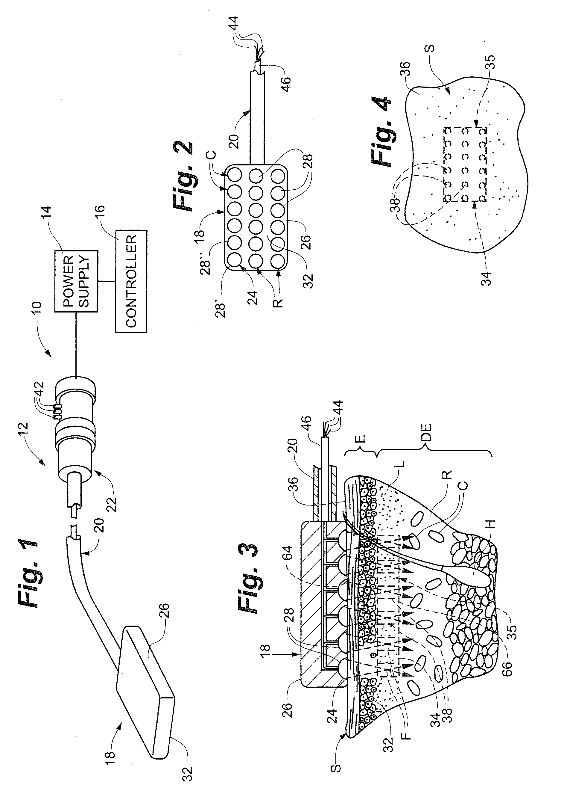 Methods of using high intensity focused ultrasound to form an ablated tissue area containing a plurality of lesions