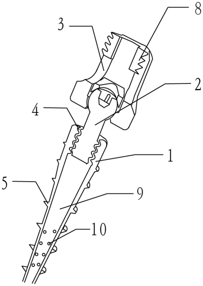 Pelvic fracture front ring fixing detachable screw and internal fixing device