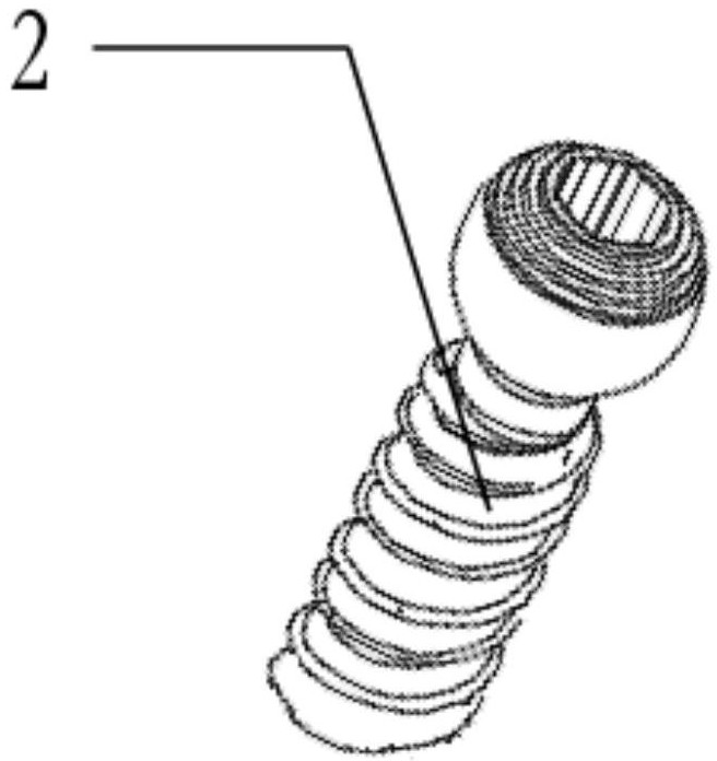 Pelvic fracture front ring fixing detachable screw and internal fixing device