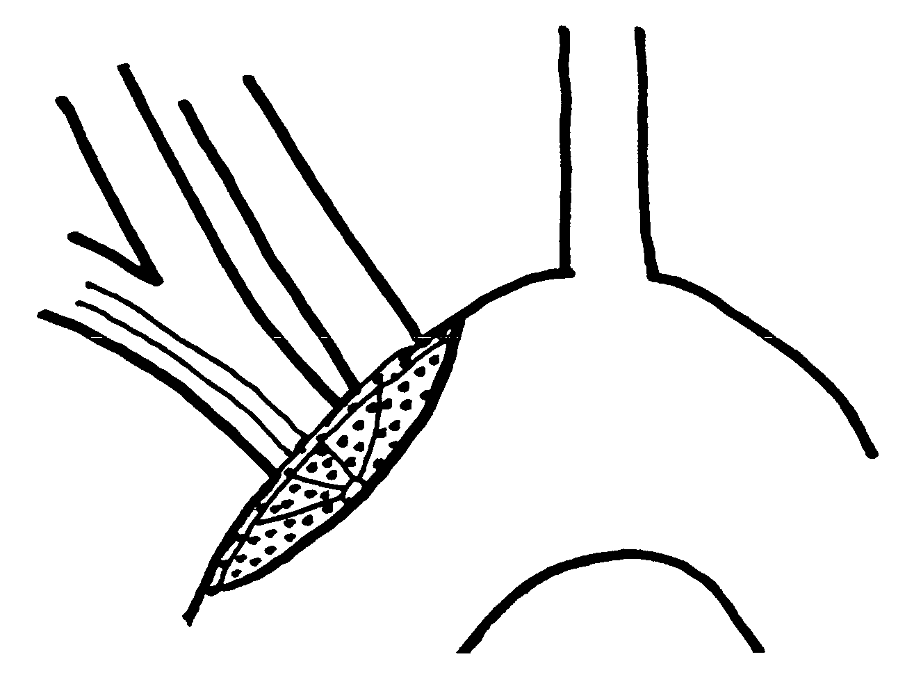 Embolic protection device and method of use