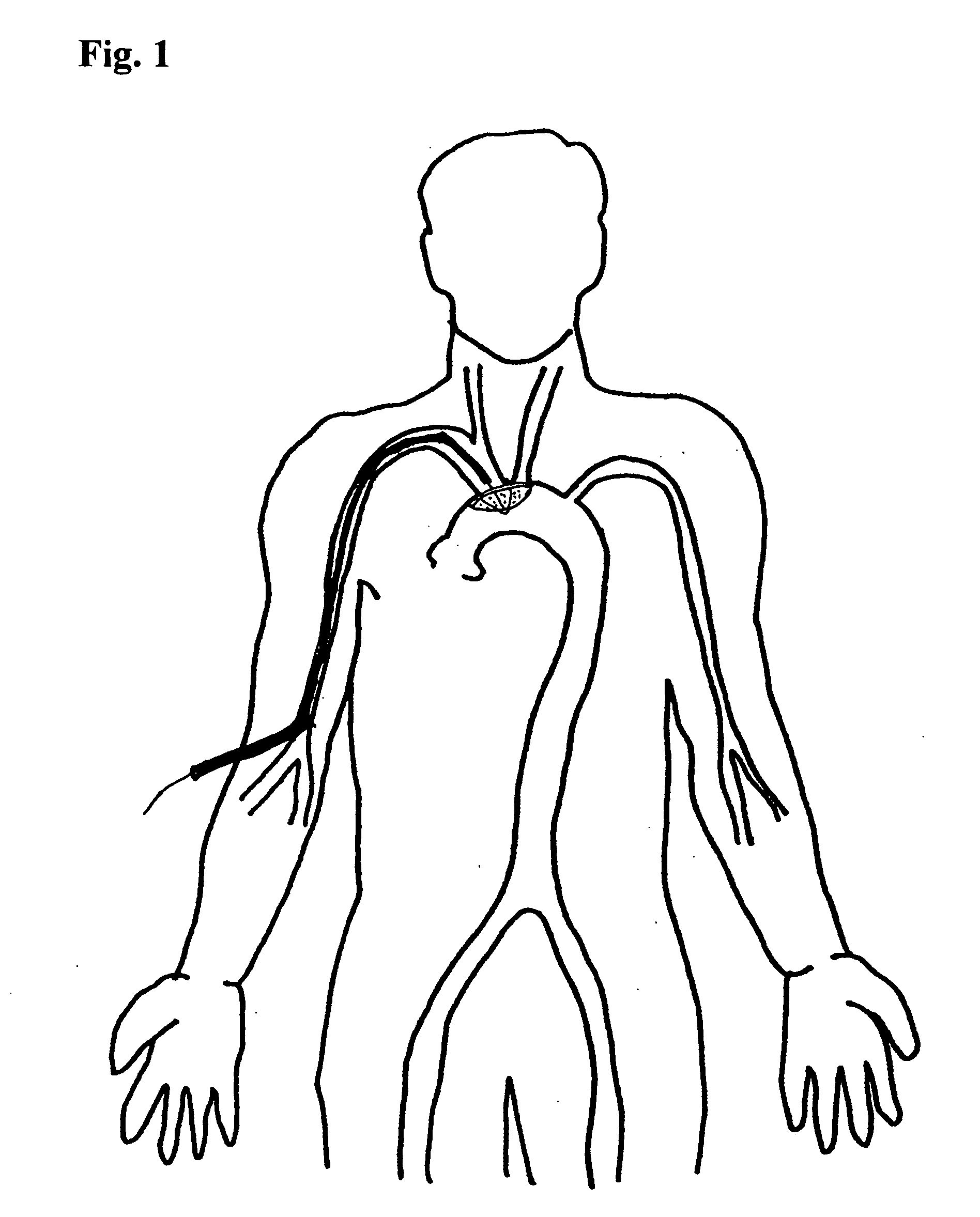 Embolic protection device and method of use