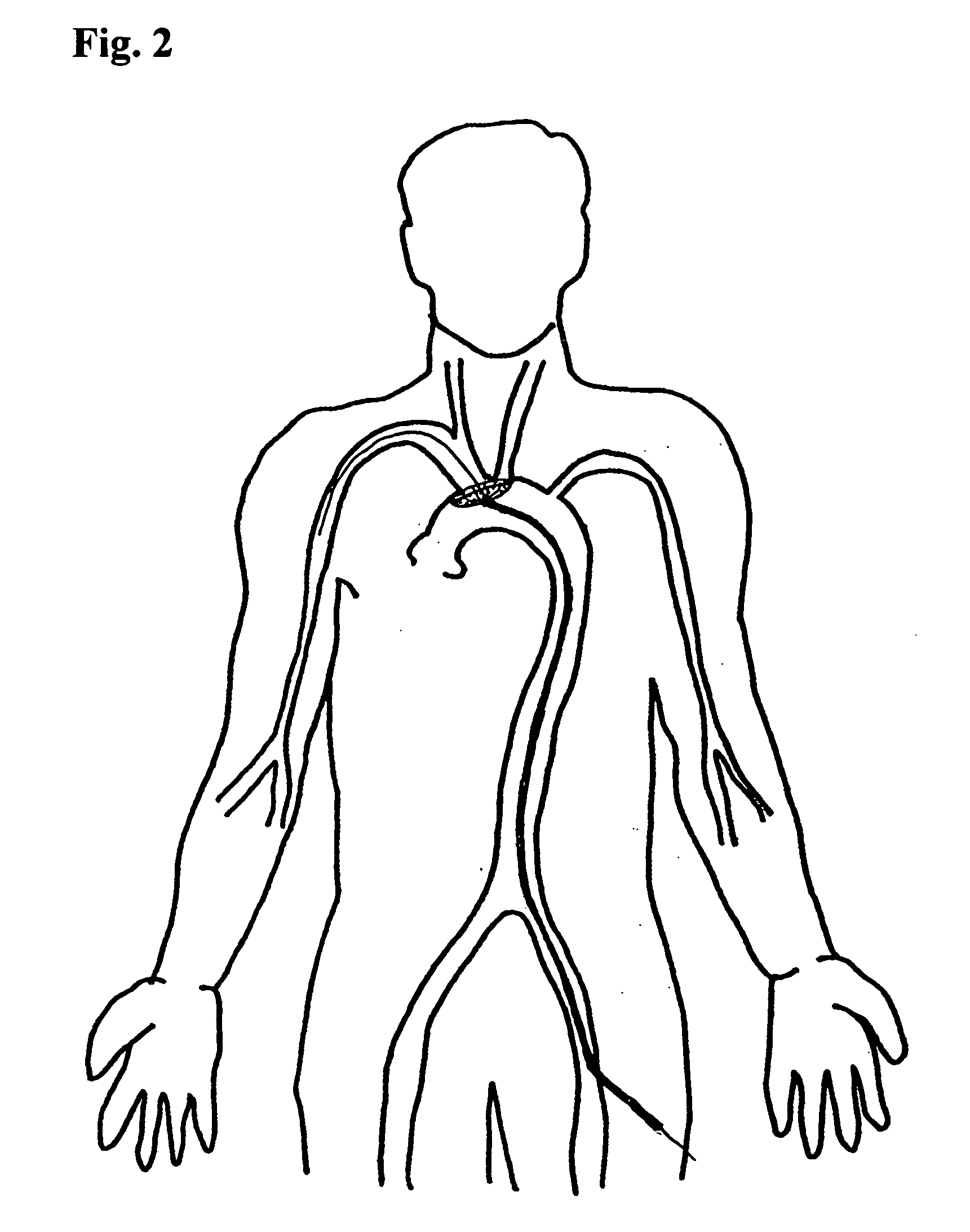 Embolic protection device and method of use