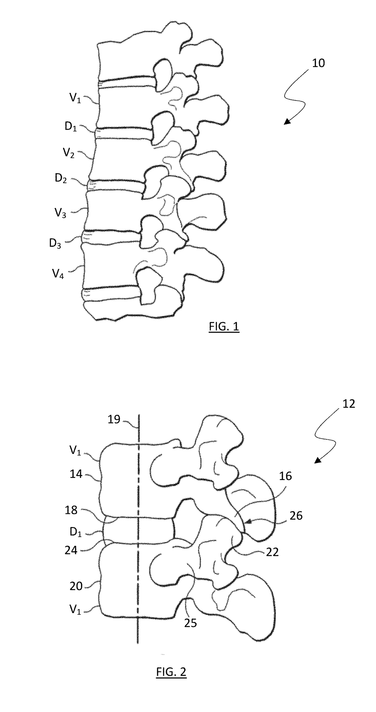 Spinal osteotomy