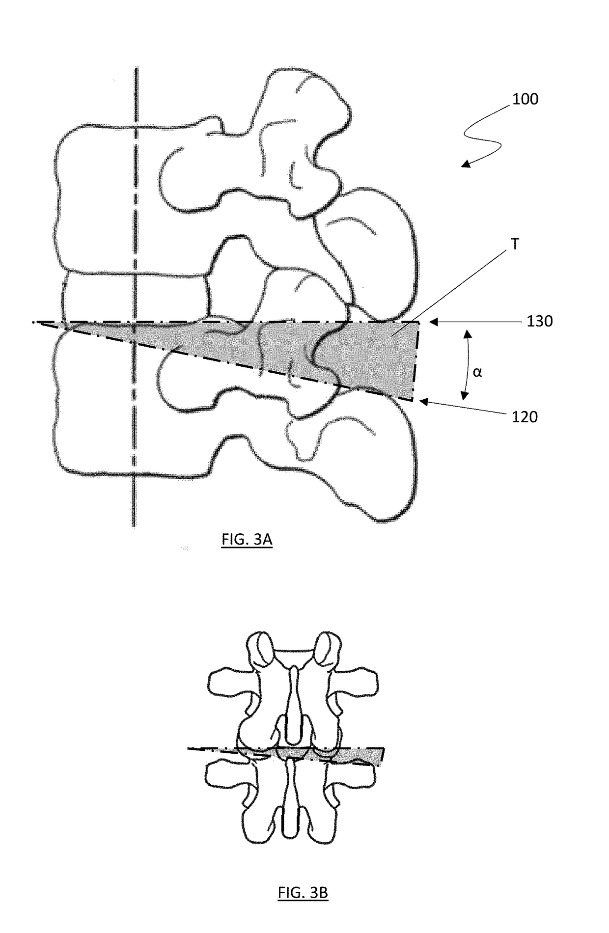 Spinal osteotomy