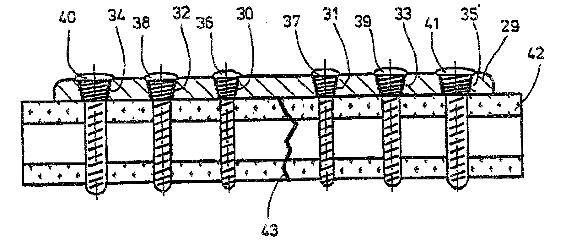 Fixation system for bones