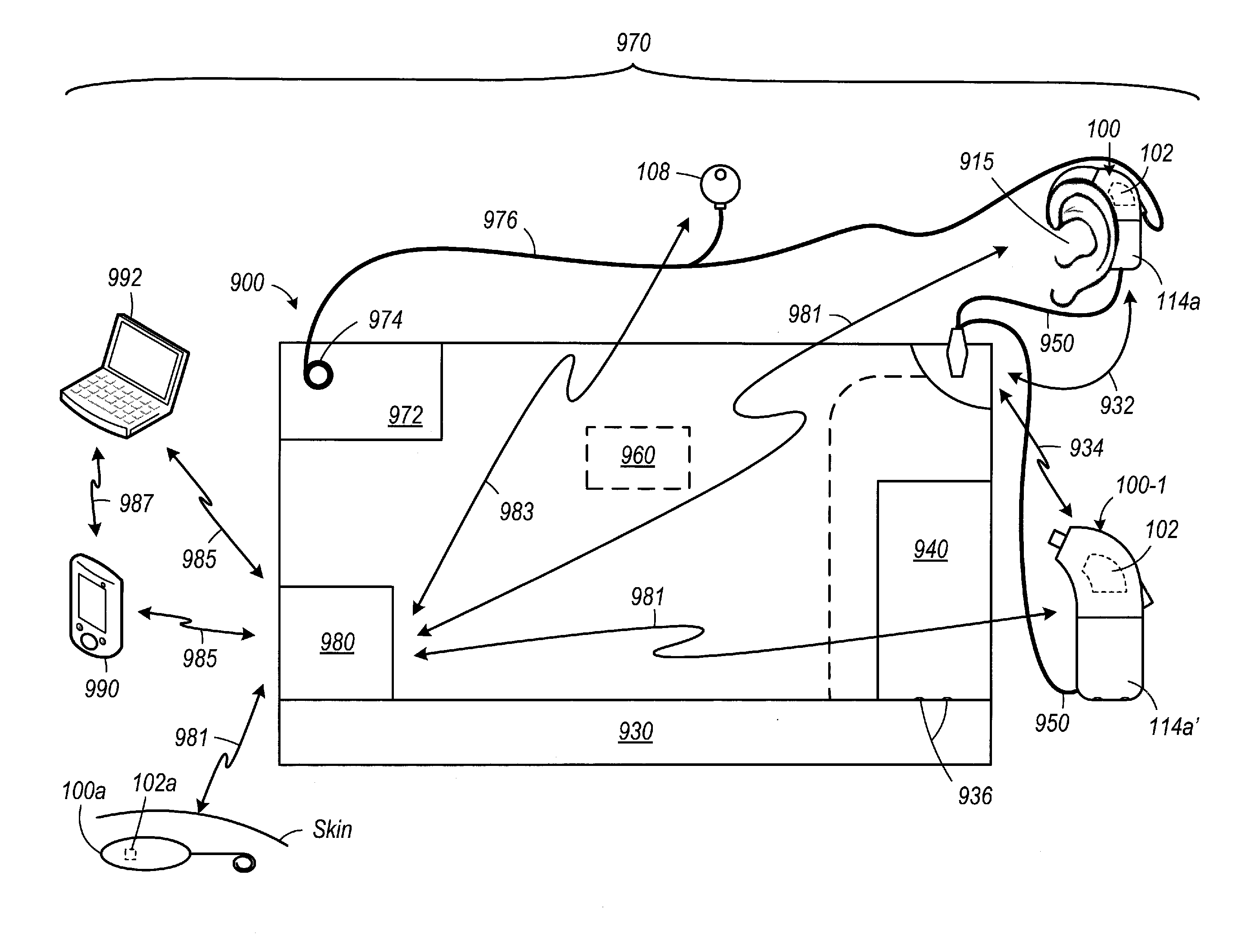 Speech processor cases