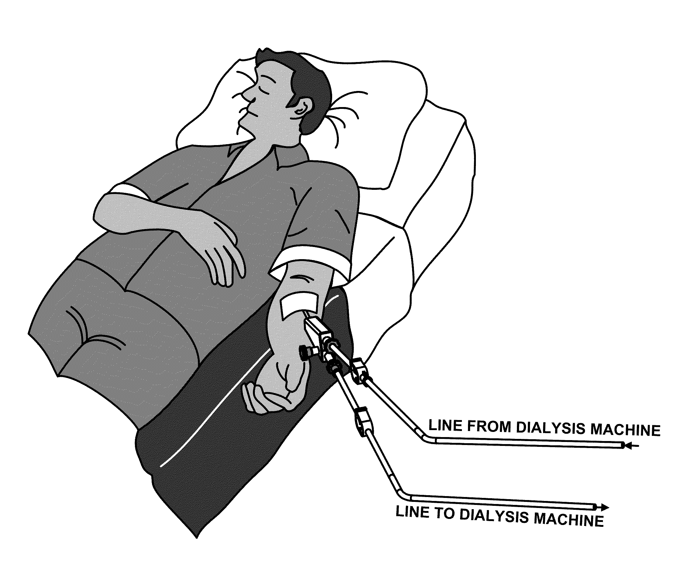 Vascular access device for hemodialysis