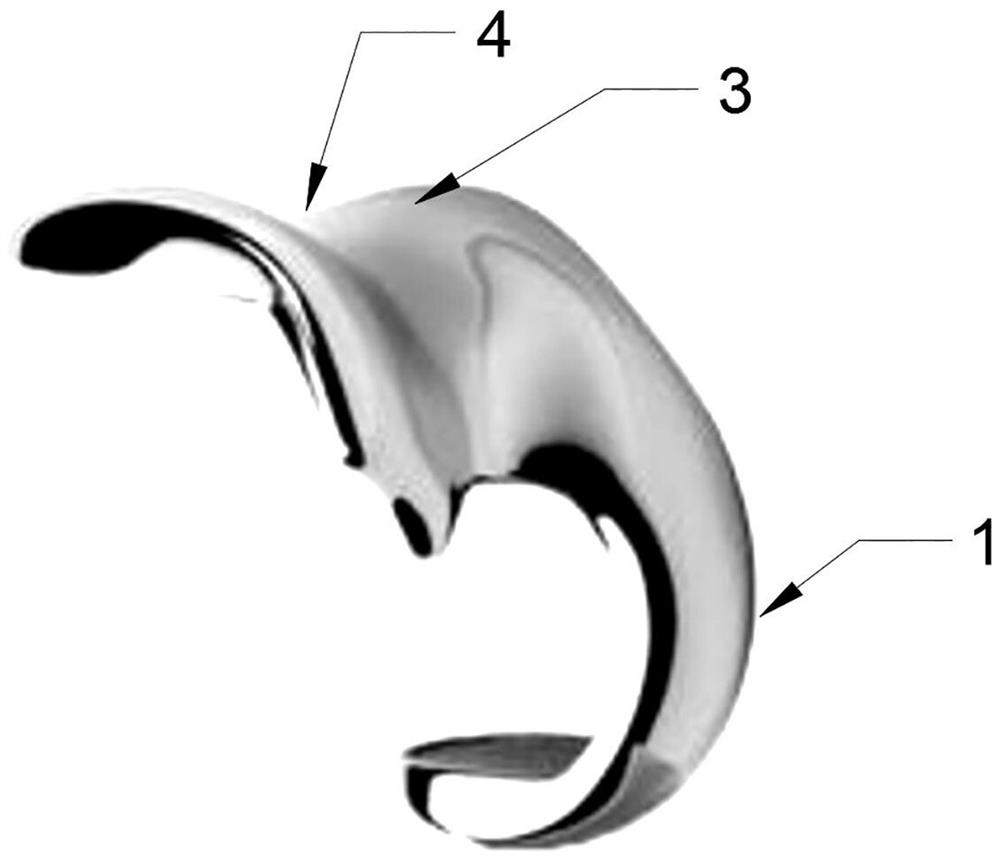 Knee joint local prosthesis and personalized design method thereof