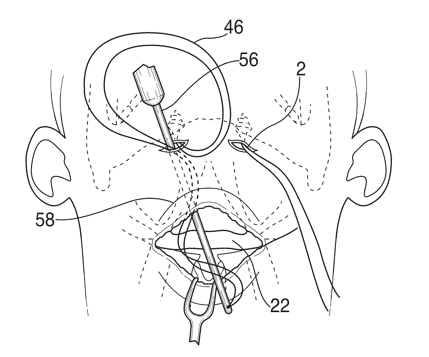 Hyoid suspension for obstructive sleep apnea