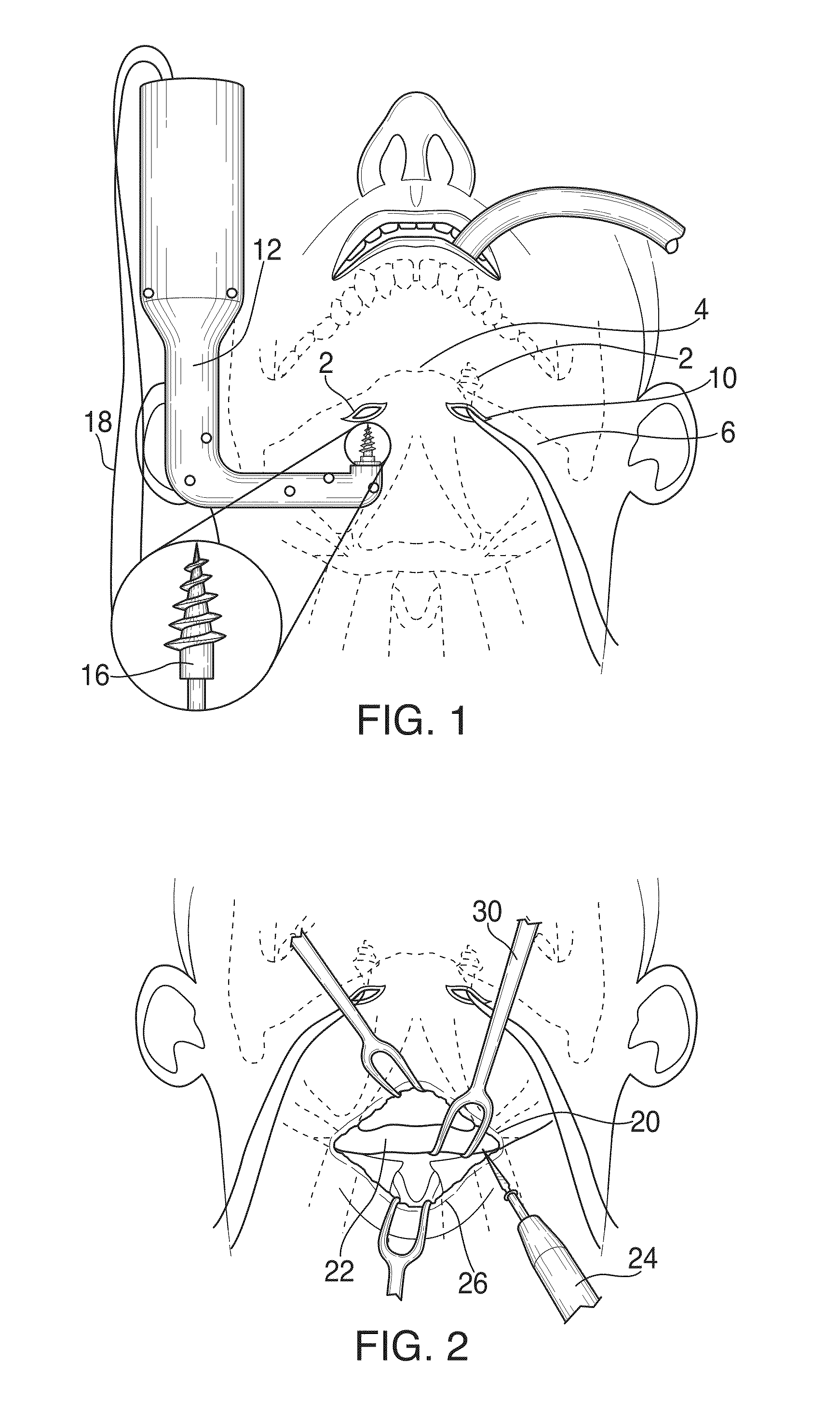 Hyoid suspension for obstructive sleep apnea