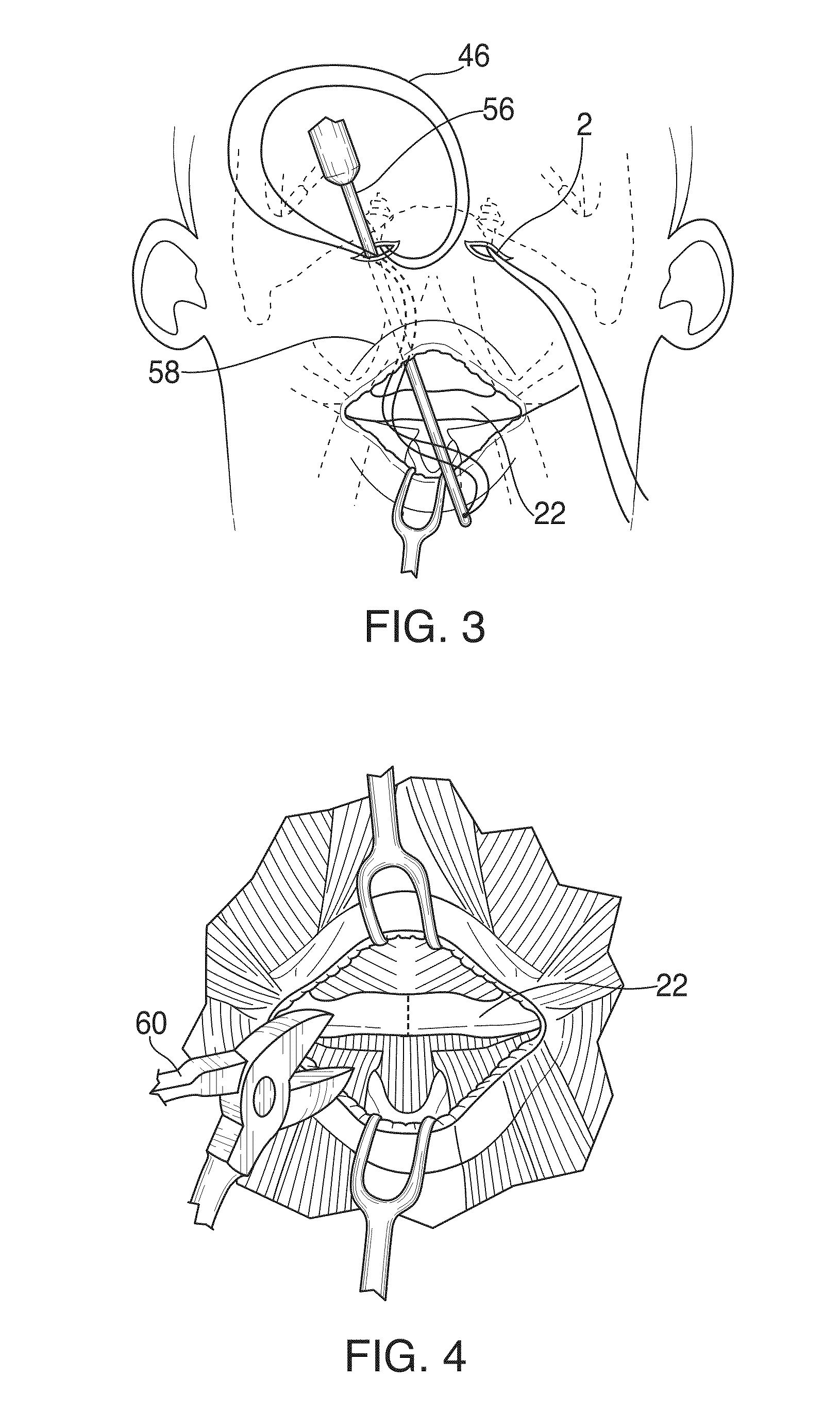 Hyoid suspension for obstructive sleep apnea