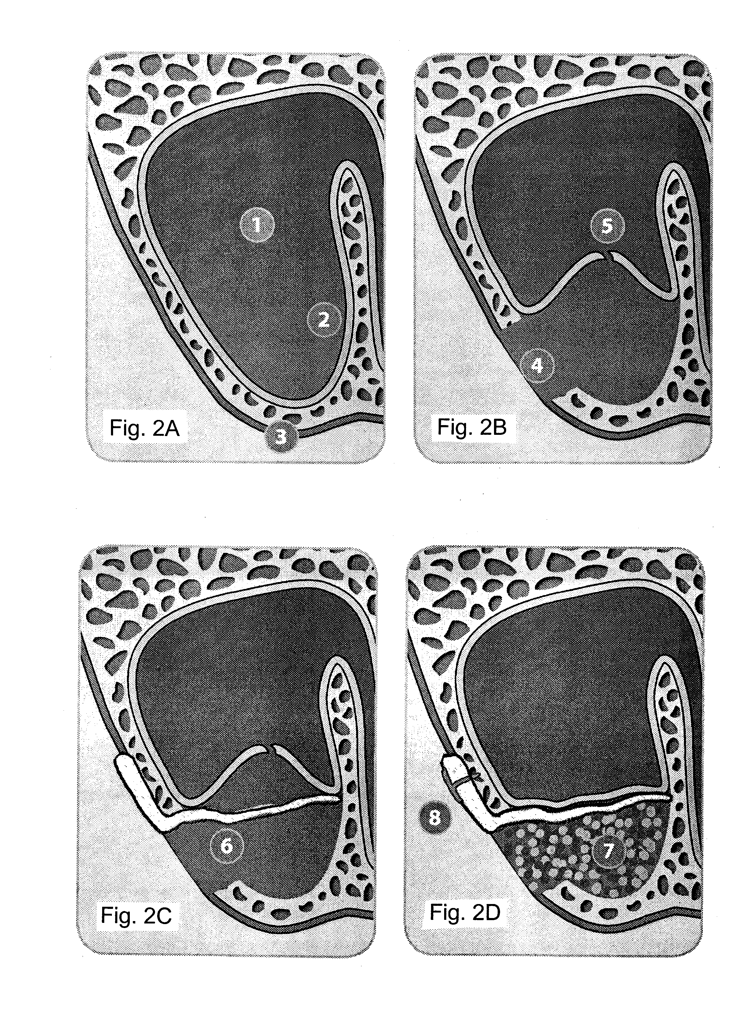 Collagen Biomaterial Wedge