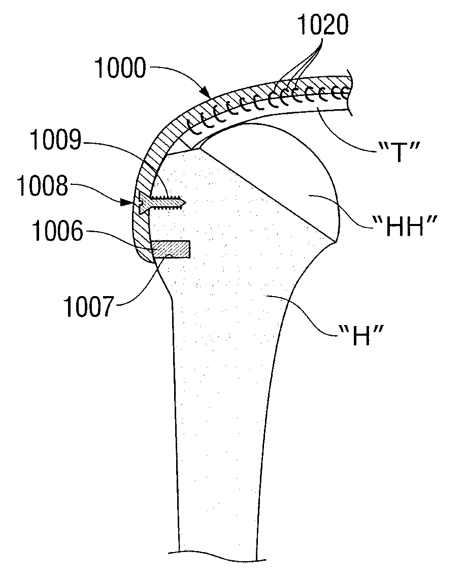 Reinforced Tissue Patch