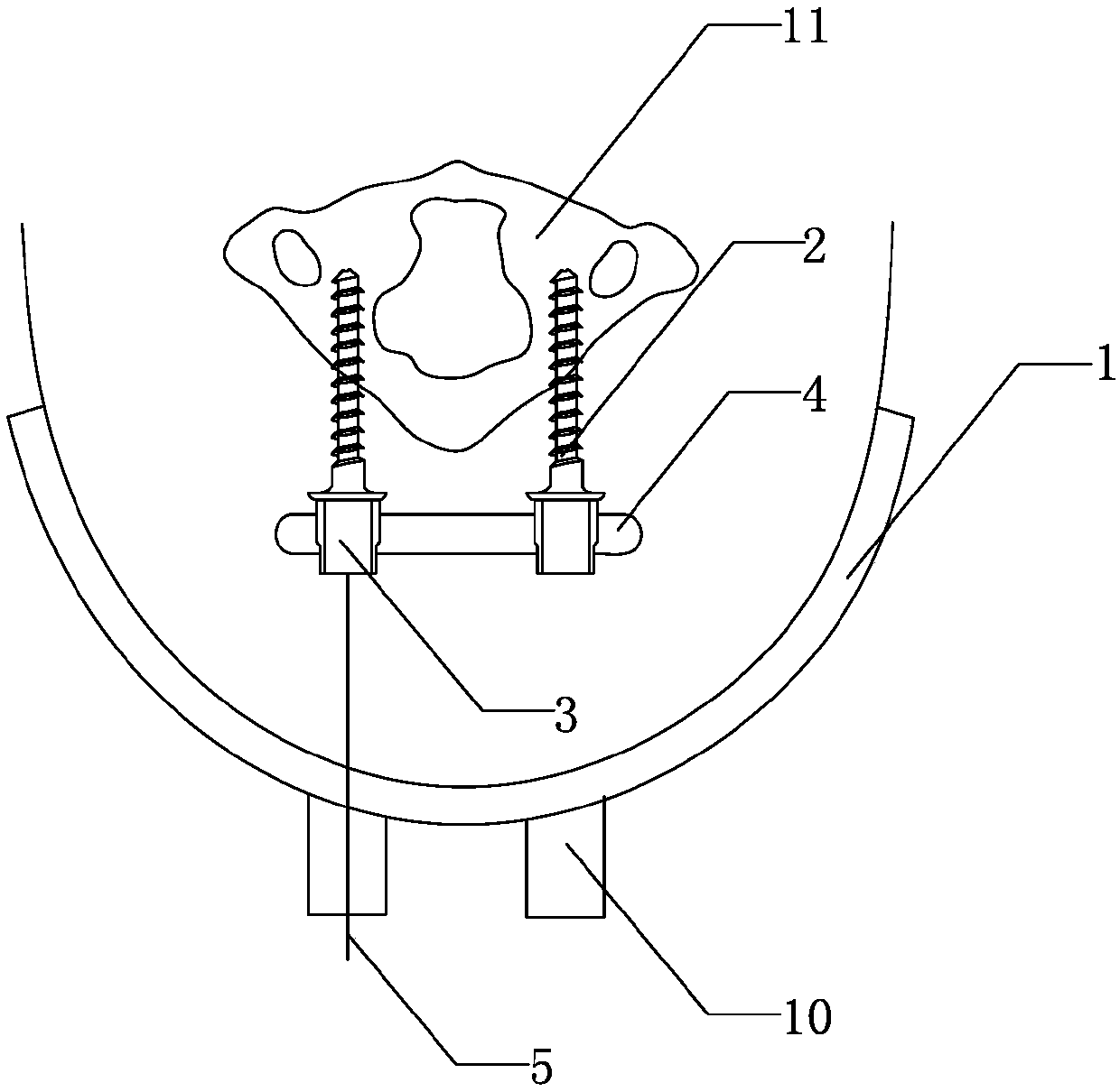 Minimally Invasive Percutaneous Atlas Posterior Internal Fixation System