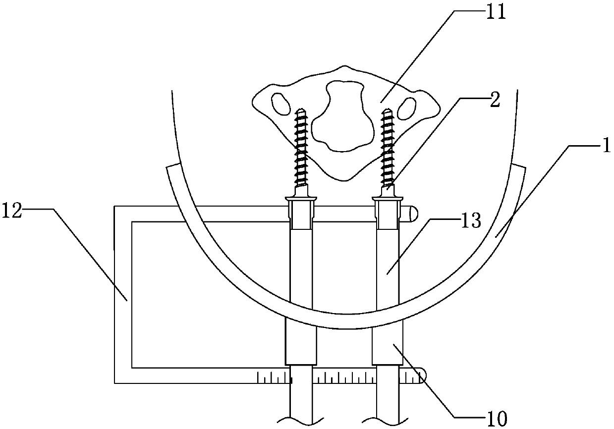 Minimally Invasive Percutaneous Atlas Posterior Internal Fixation System