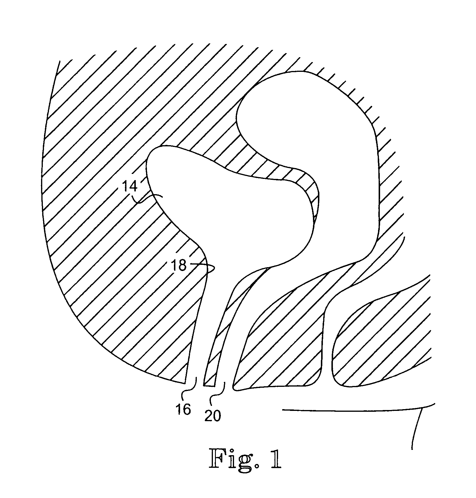 Floating sling for treatment of incontinence