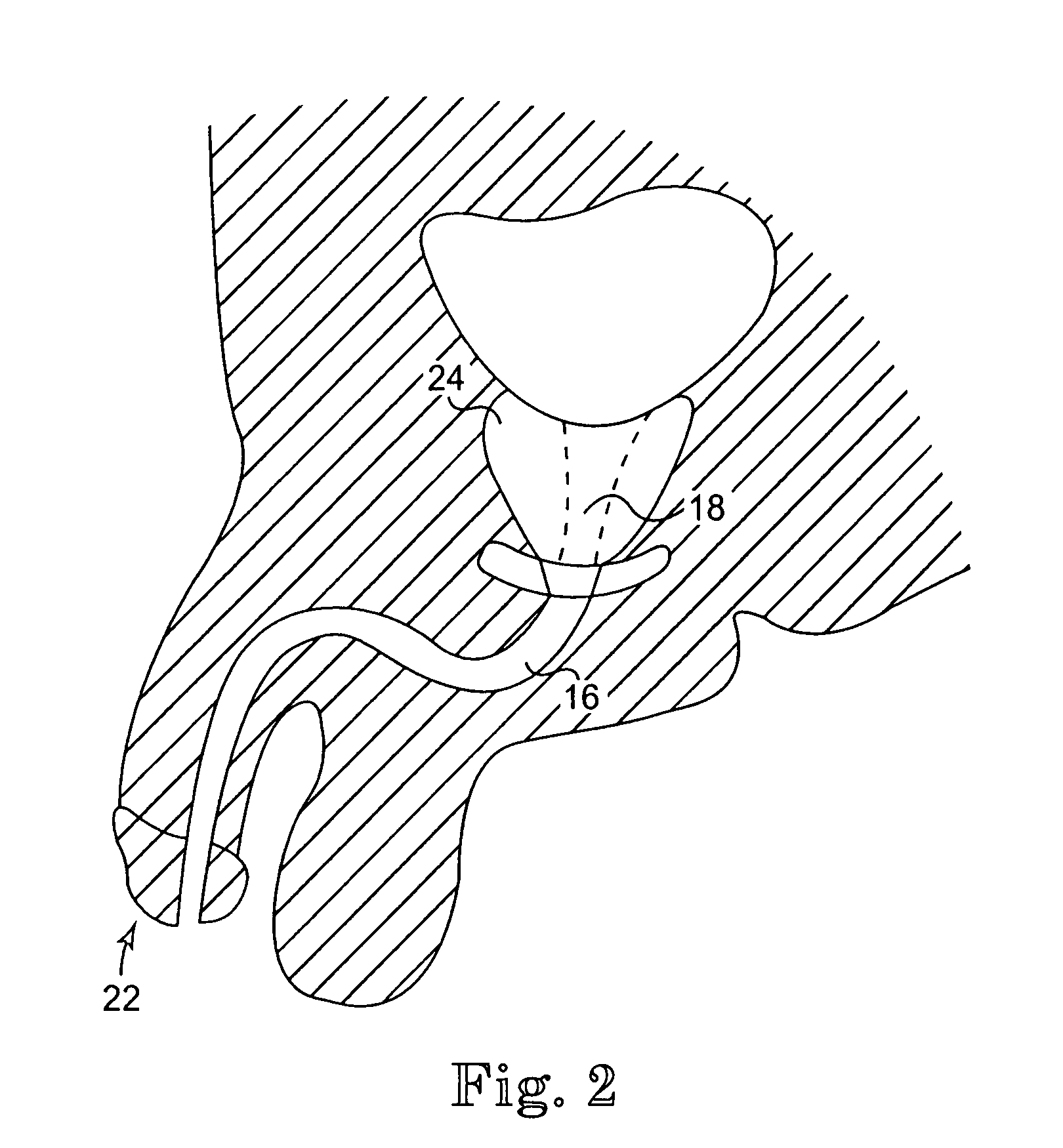 Floating sling for treatment of incontinence